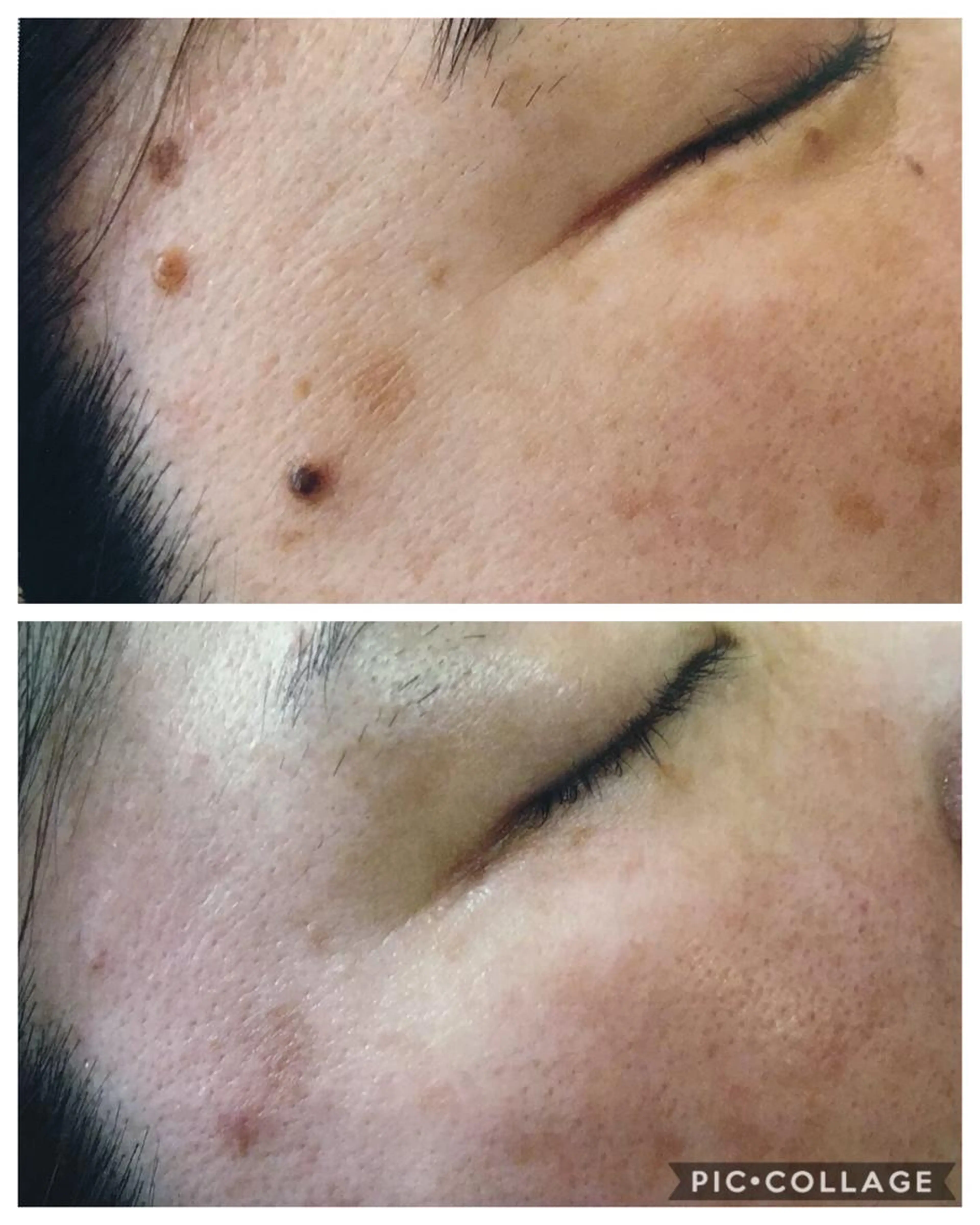 お首花イボ取り　お顔のイボ取り　お顔シミ取りの写真