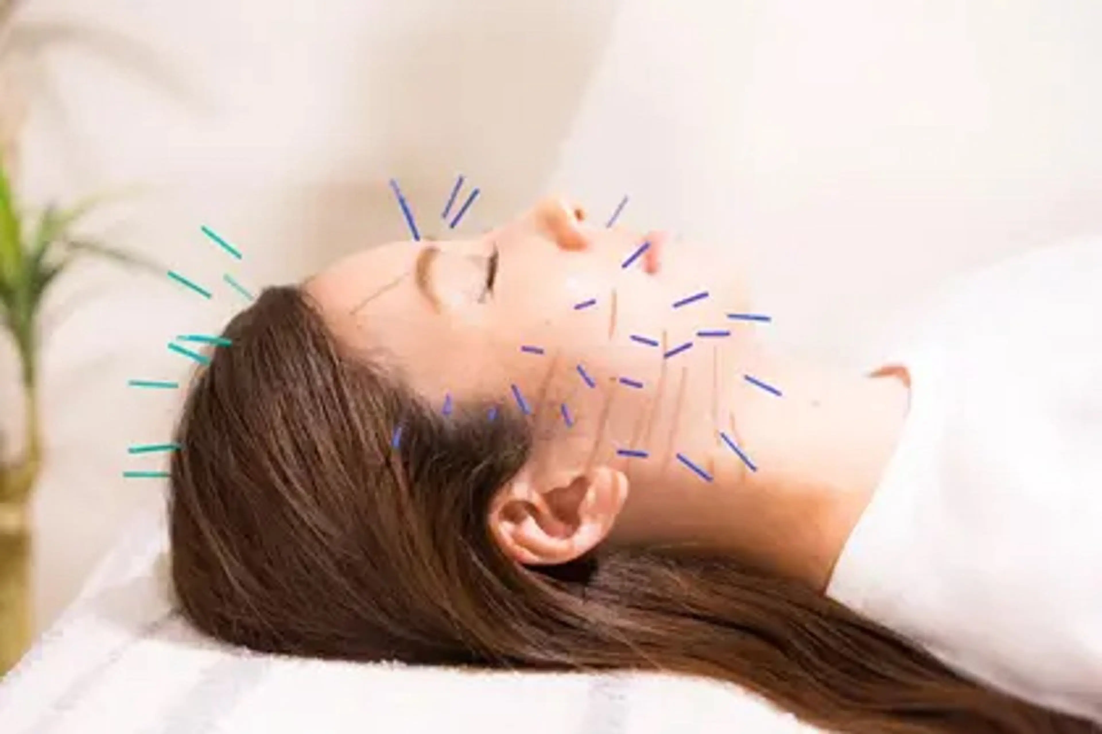 【むくみ/エラ張り/肌荒れ改善🔥美容鍼の本数約80本以上】初回50%off《美顔鍼/50分/6,000円》の写真