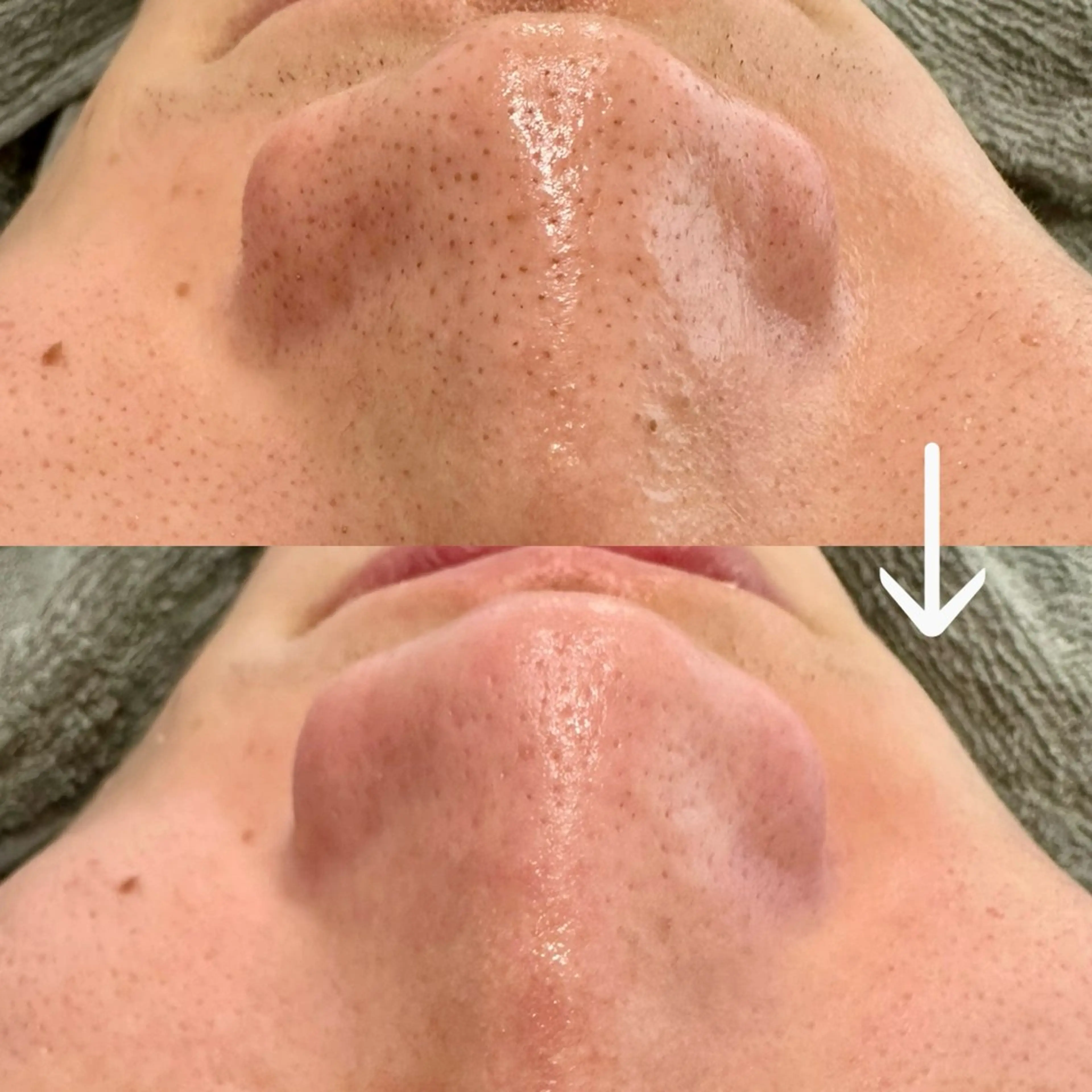 【韓国式3D毛穴洗浄×水分補給】超音波美容液導入♪黒ずみ•ざらつきごっそり‼️5,000円✨の写真