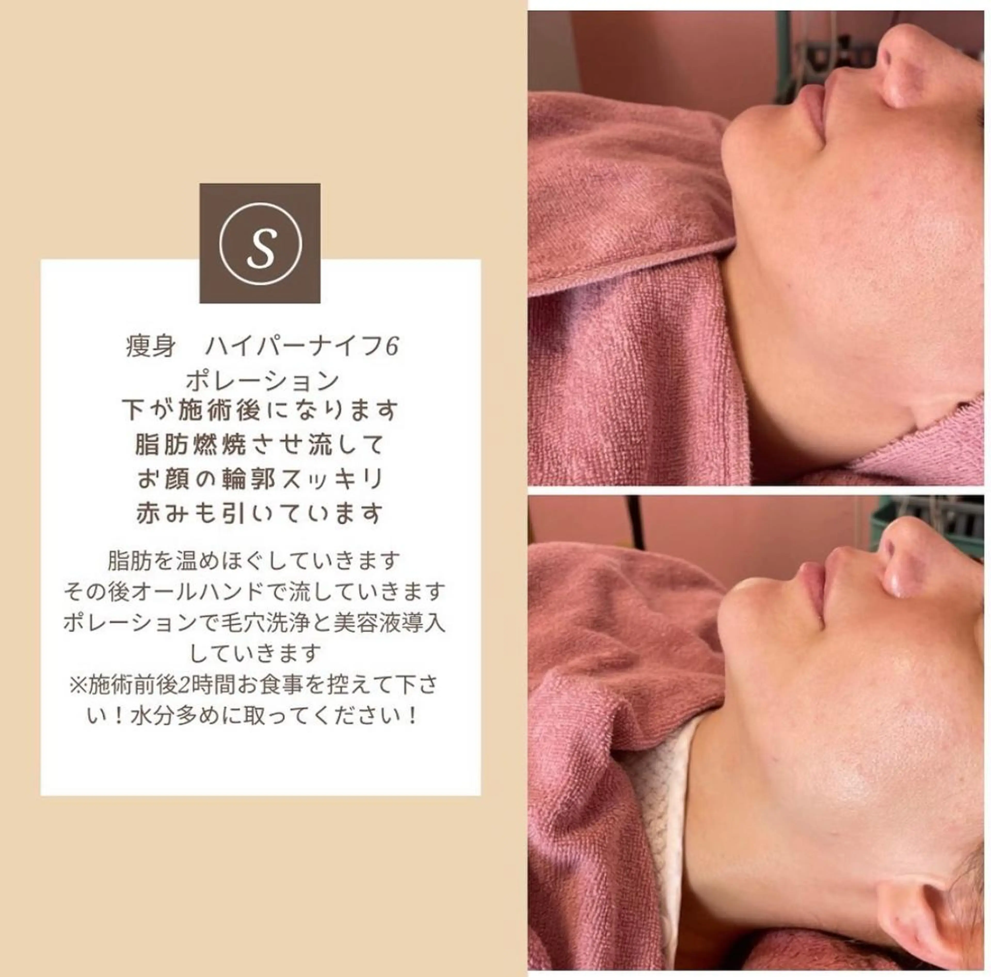 小顔ハイパーナイフ+リンパマッサージの写真