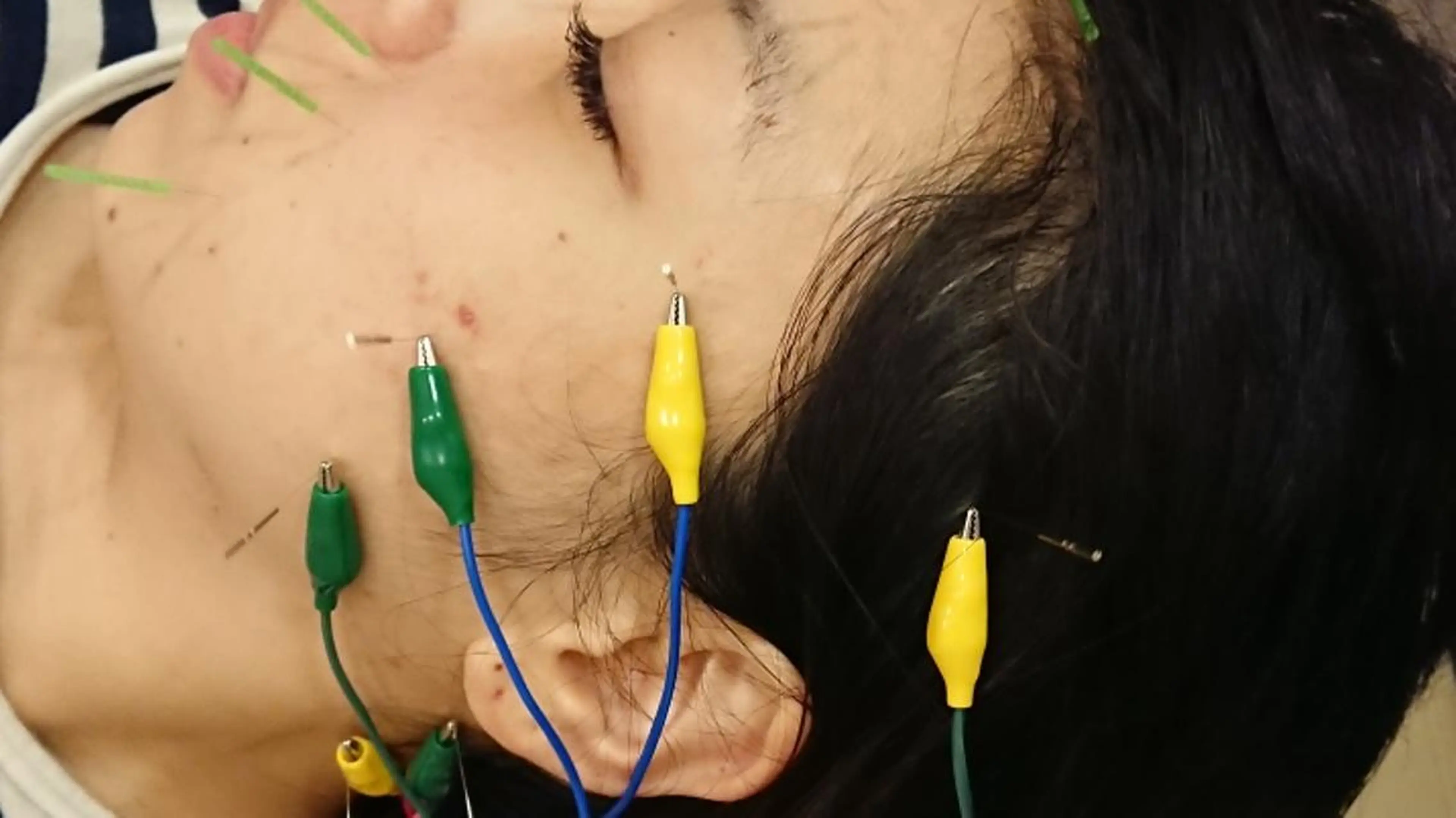 【初回美容鍼】“40本の電気でググっとリフトアップする小顔美容鍼”の写真