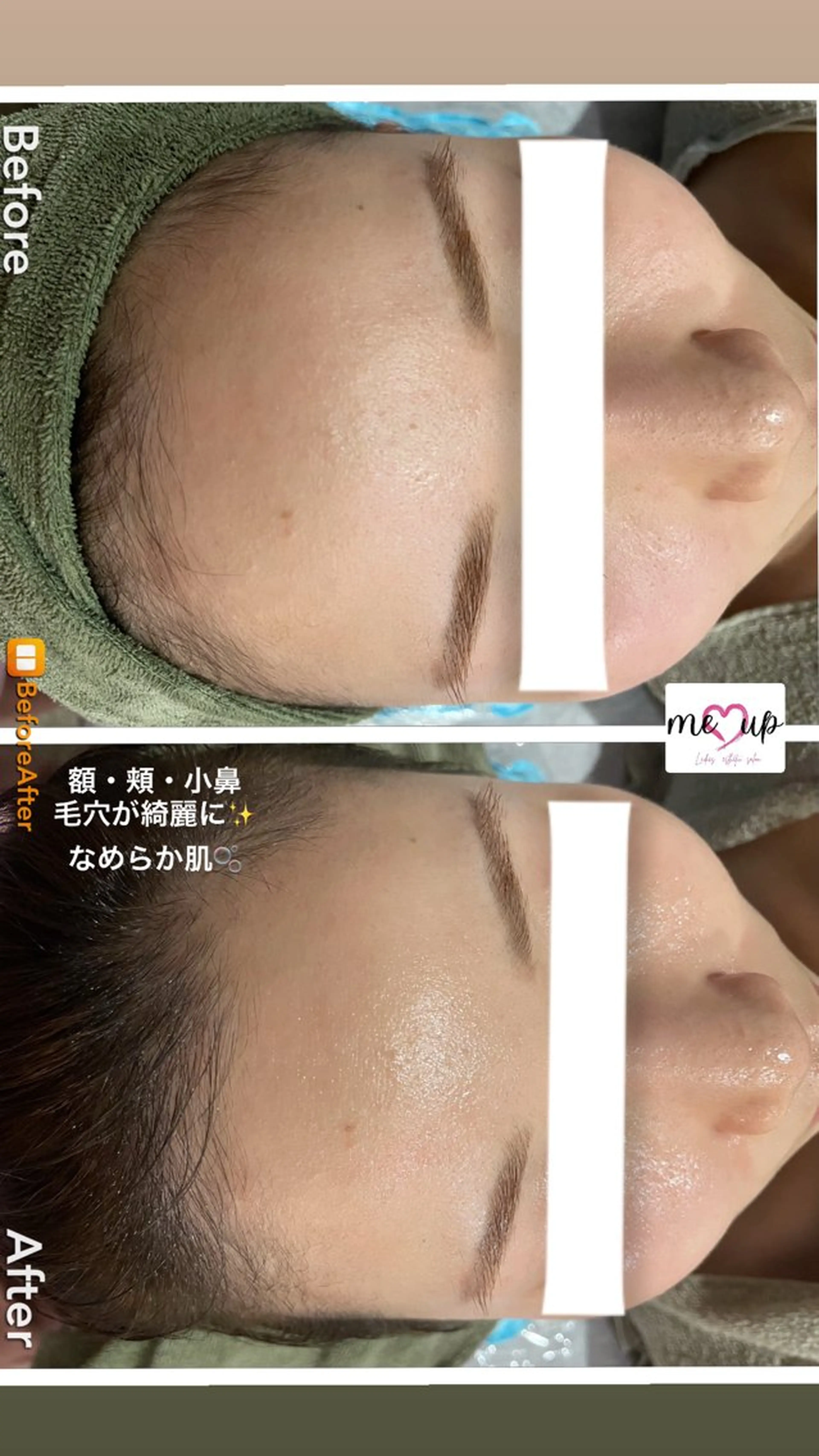 Meupニキビ専門店 背中/ハーブ/肌管理のその他イメージ