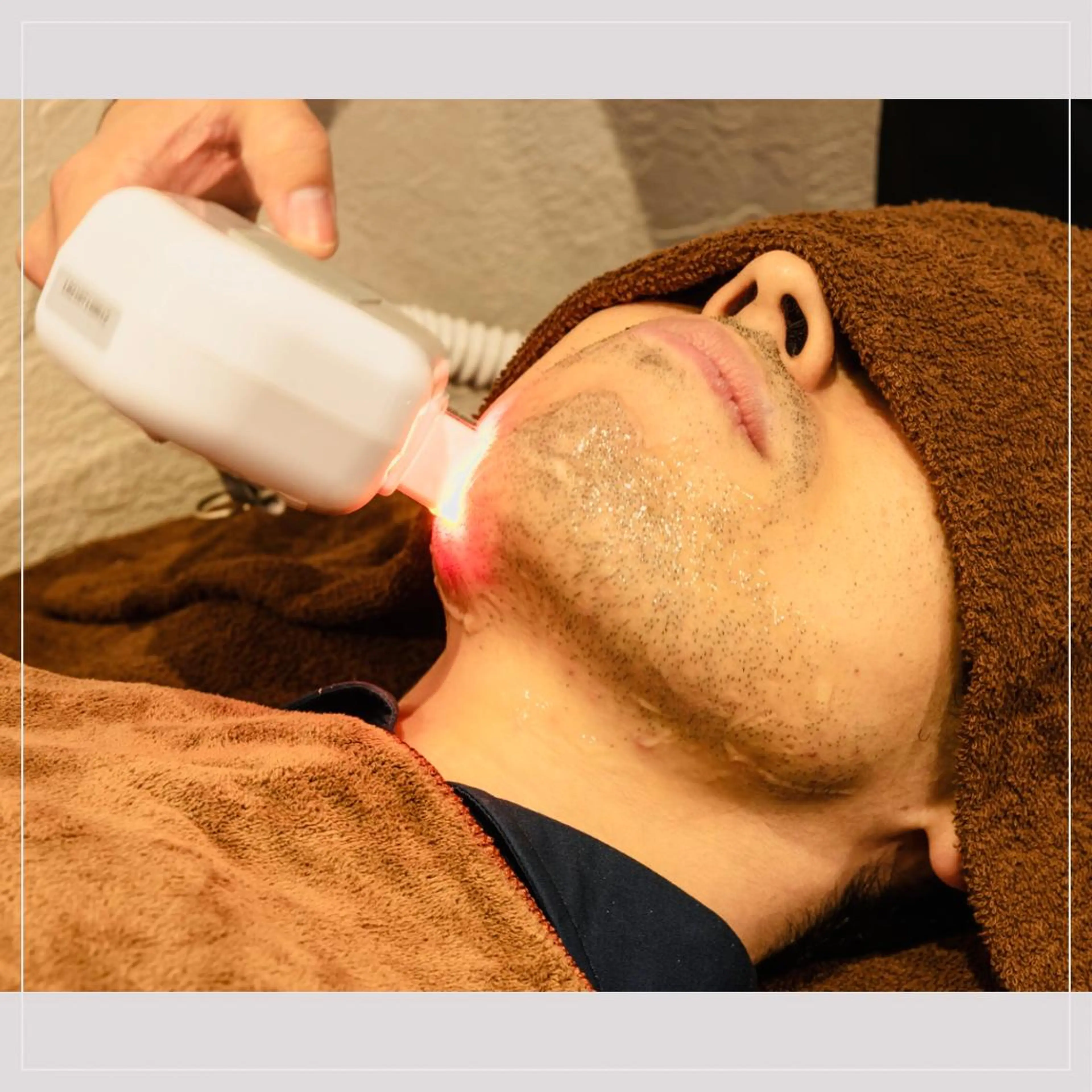 メンズ顔全体脱毛の写真