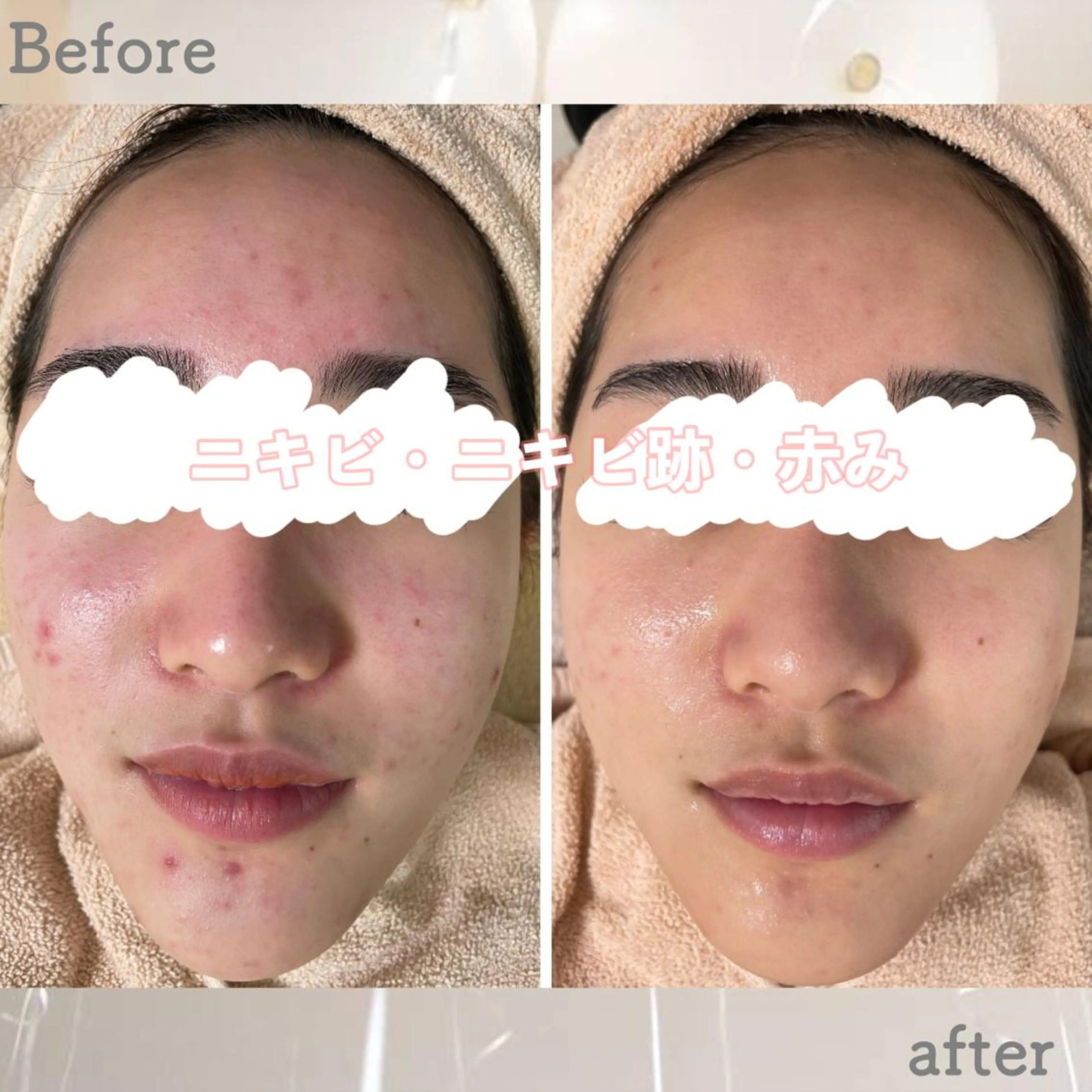 エステ ニキビ&跡改善サロン オーナー光木のエステ・リラクイメージ