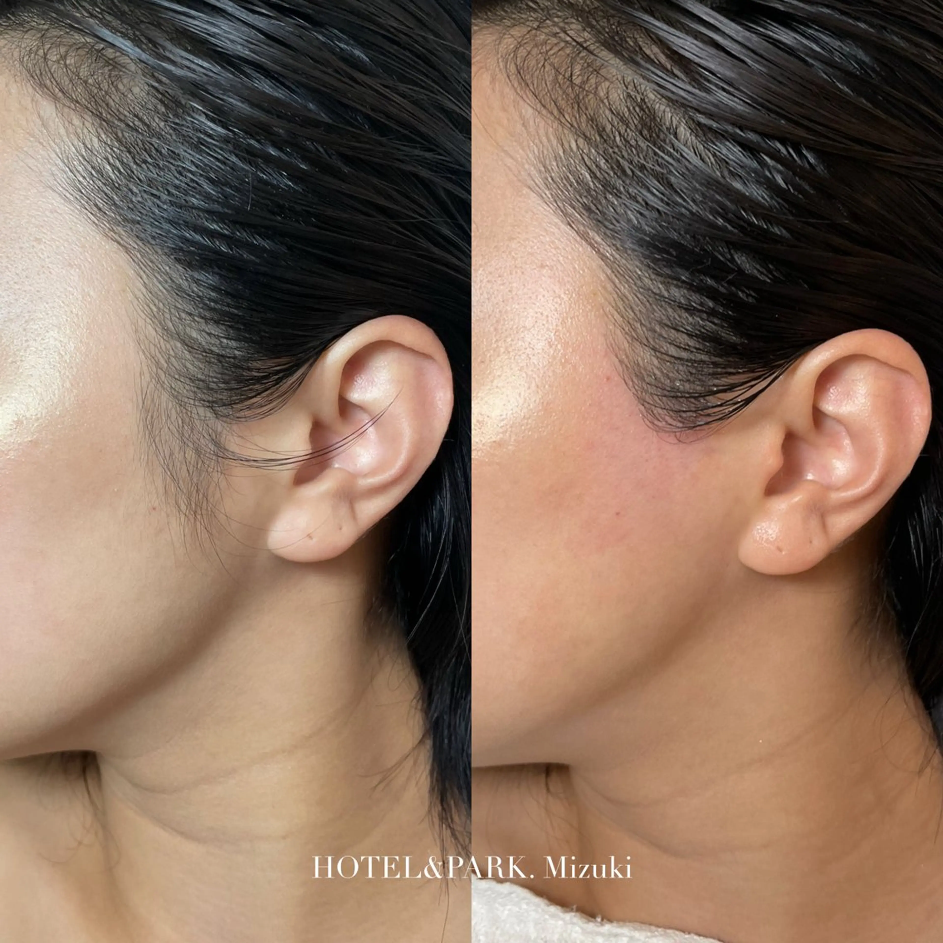 【もみあげワックス脱毛】コンプレックス一瞬で解消！の写真