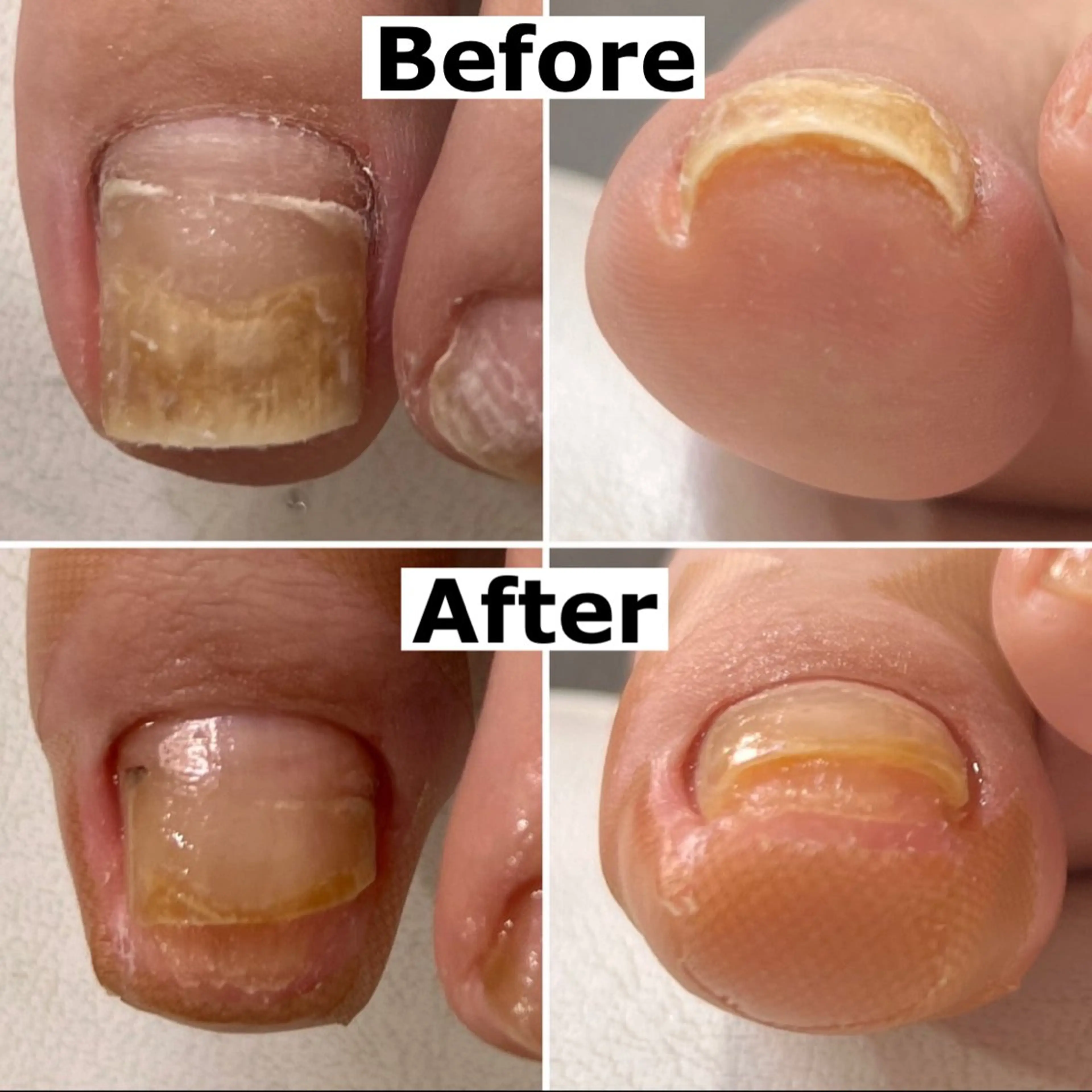 ネイル Mellow nail所属・巻爪無料モデル募集 ✨🦶MEGUMIのネイルデザイン