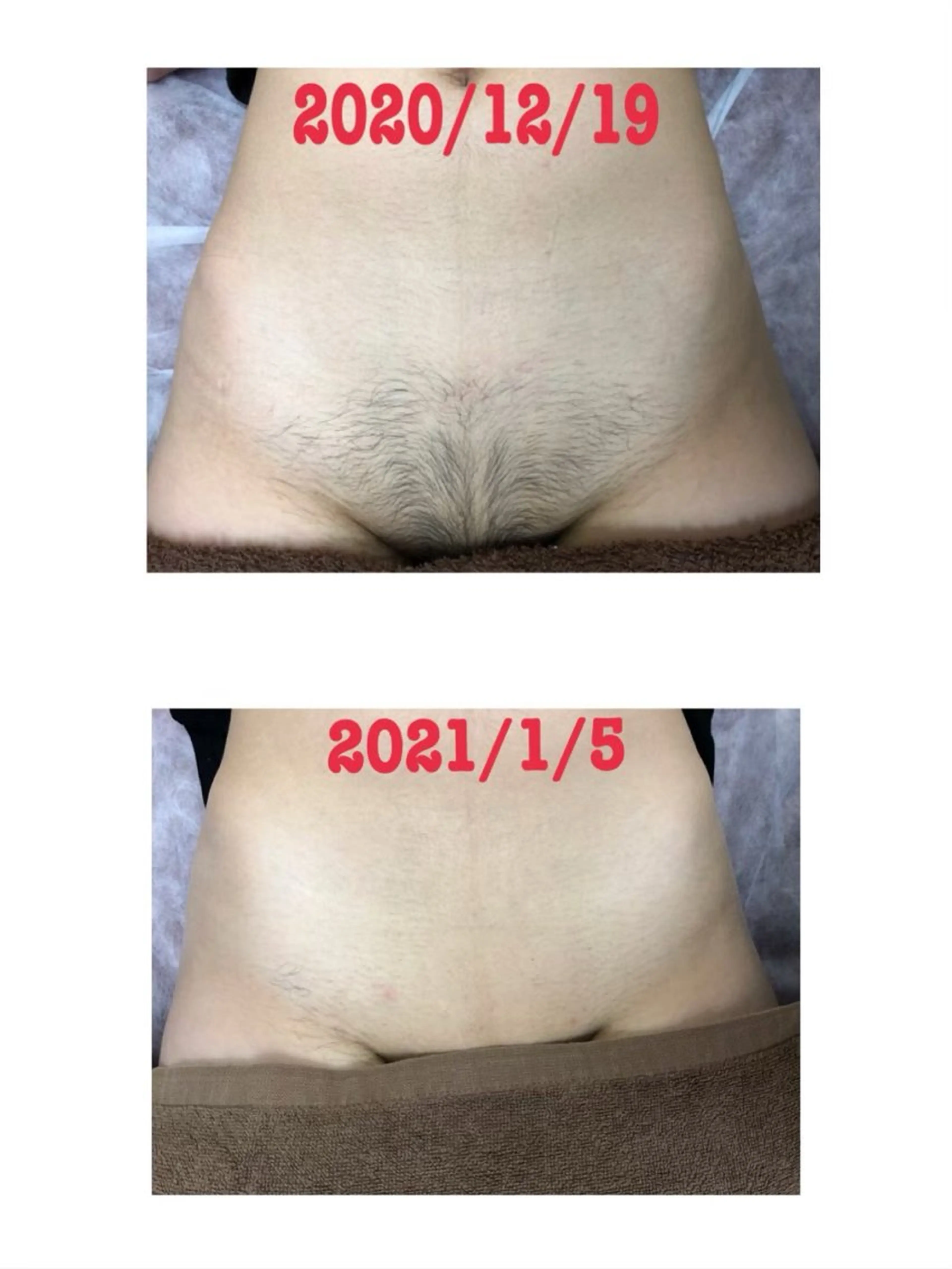 【満足度◎✨】VIO脱毛2回🌸シェービング代無料✨痛みが少ないのに1回でもスルスル抜ける劇的な効果💓の写真