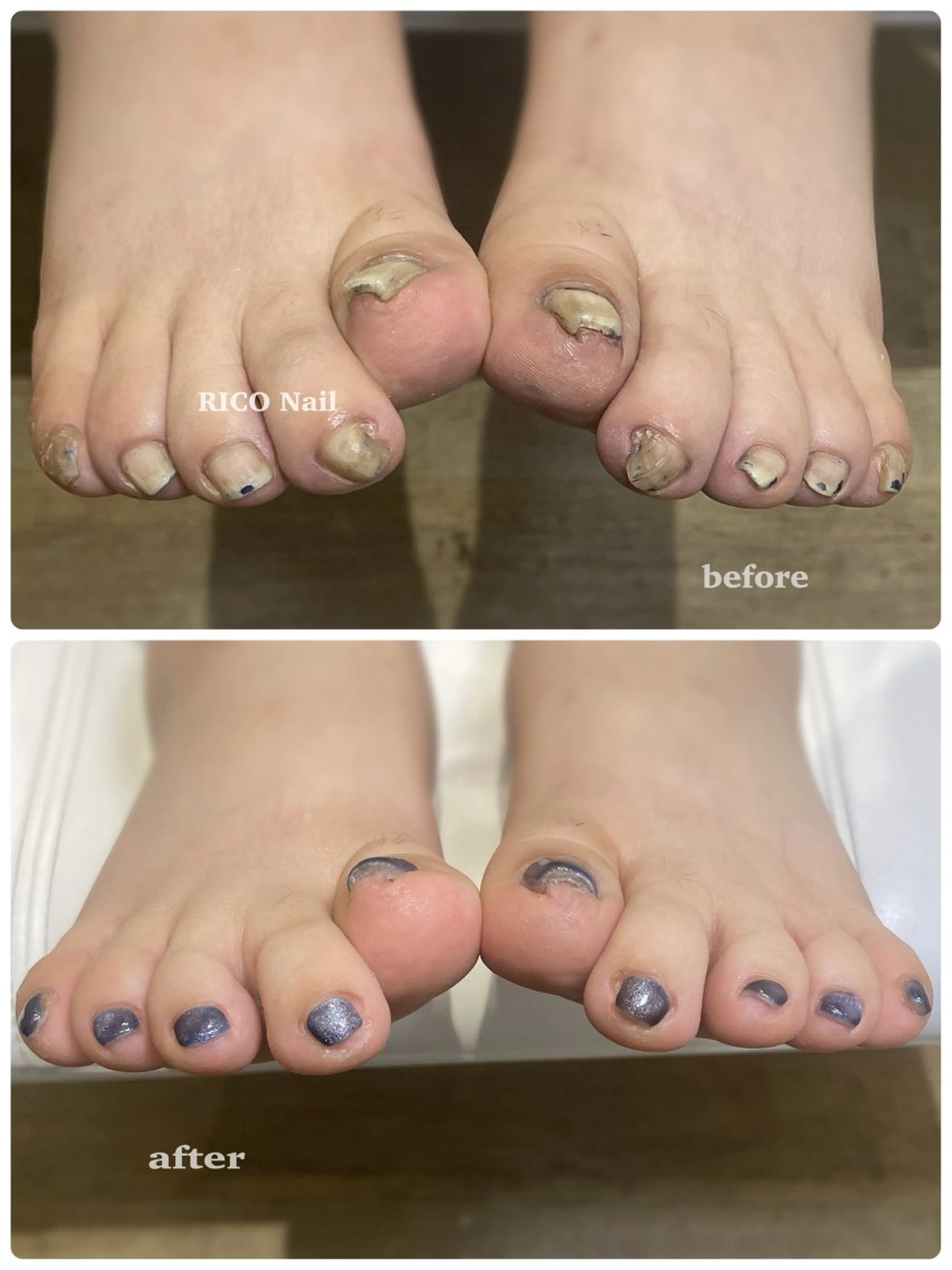 Foot🦶🏼巻き爪緩和ケア付きジェルワンカラー🍒2回分✨の写真