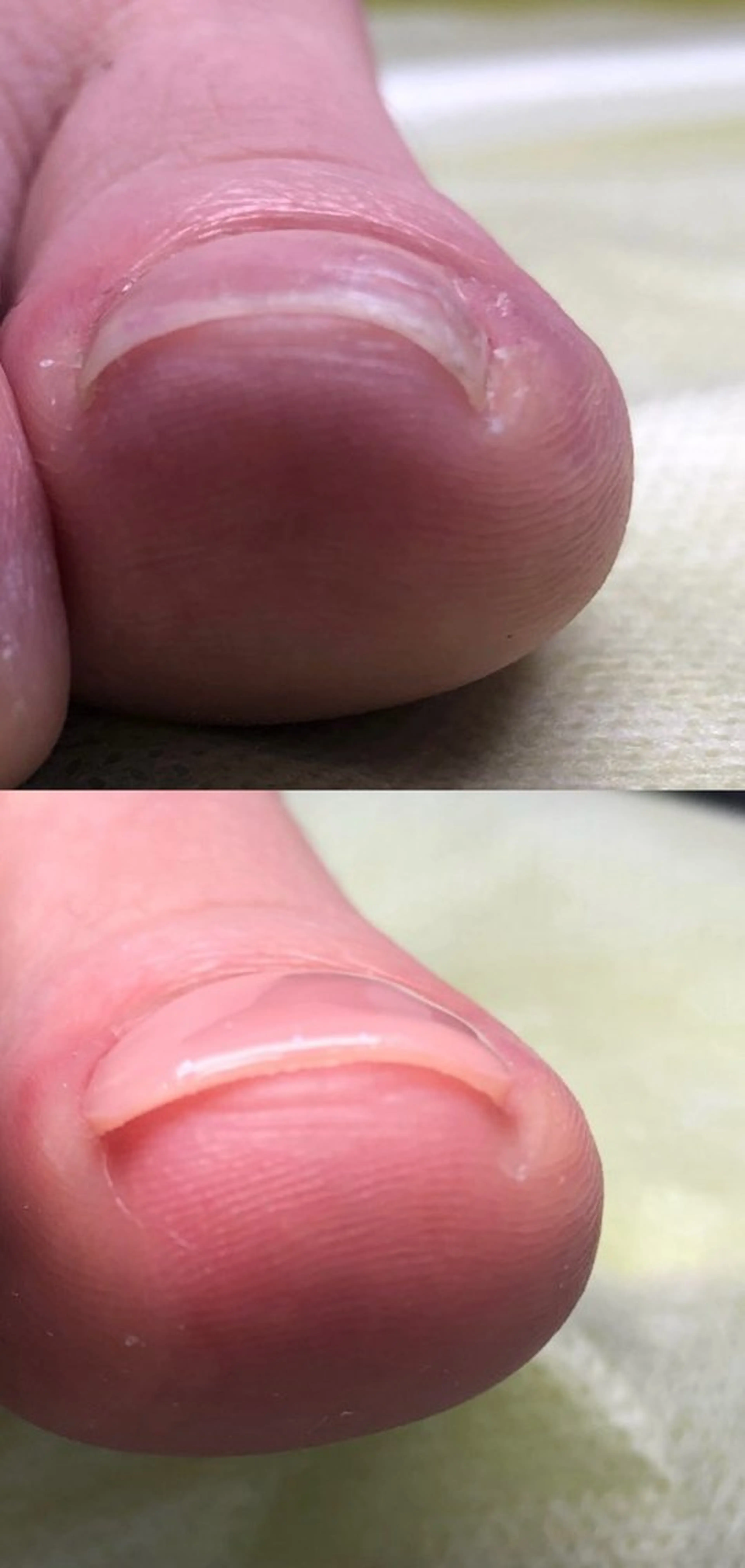 ［foot］痛くない巻き爪ケア1本+甘皮ケア《Hey switch》の写真