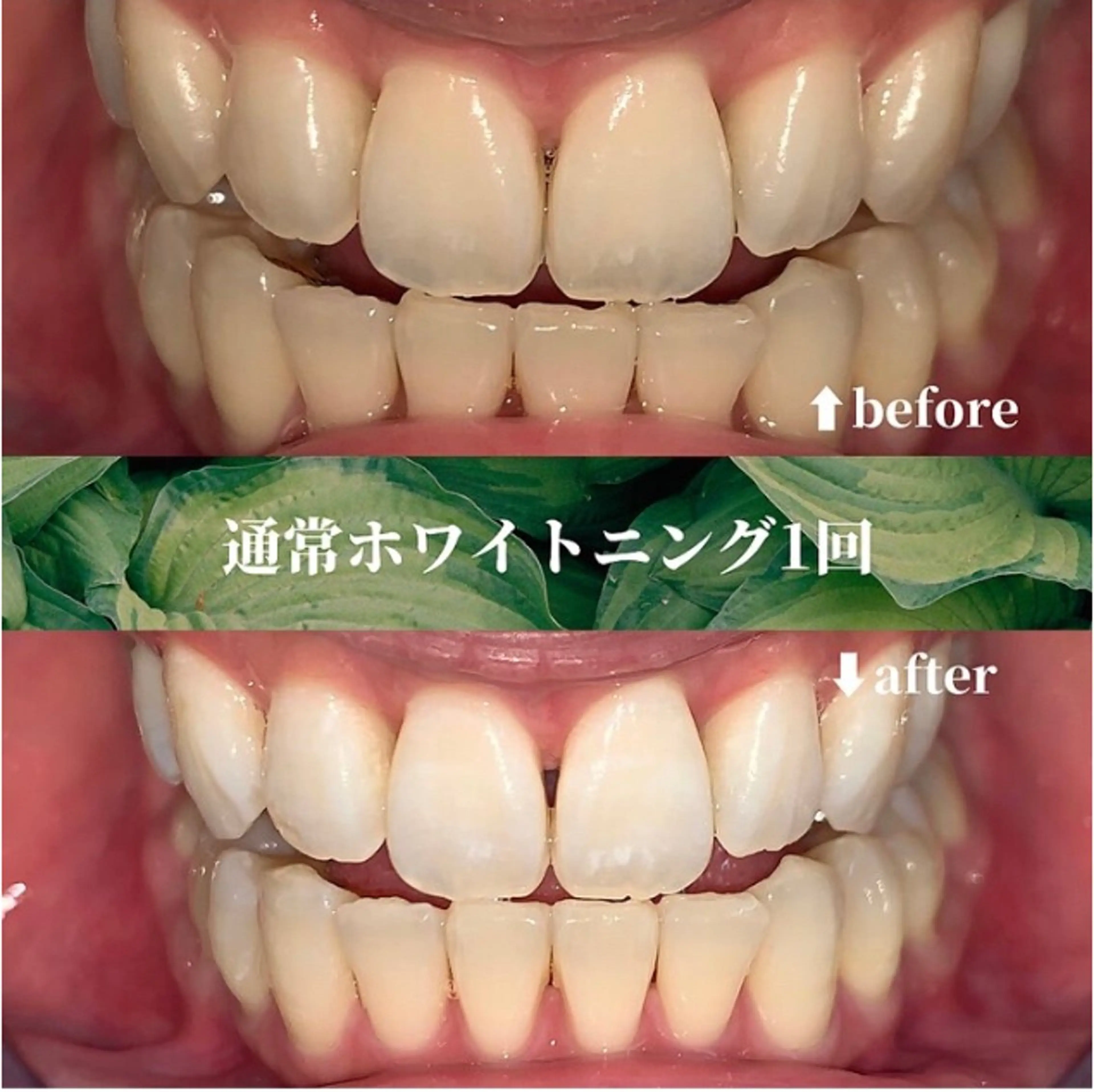 【人気No.1コスパ最強◎自然な白さへ】セルフホワイトニング30分照射　初回体験の写真