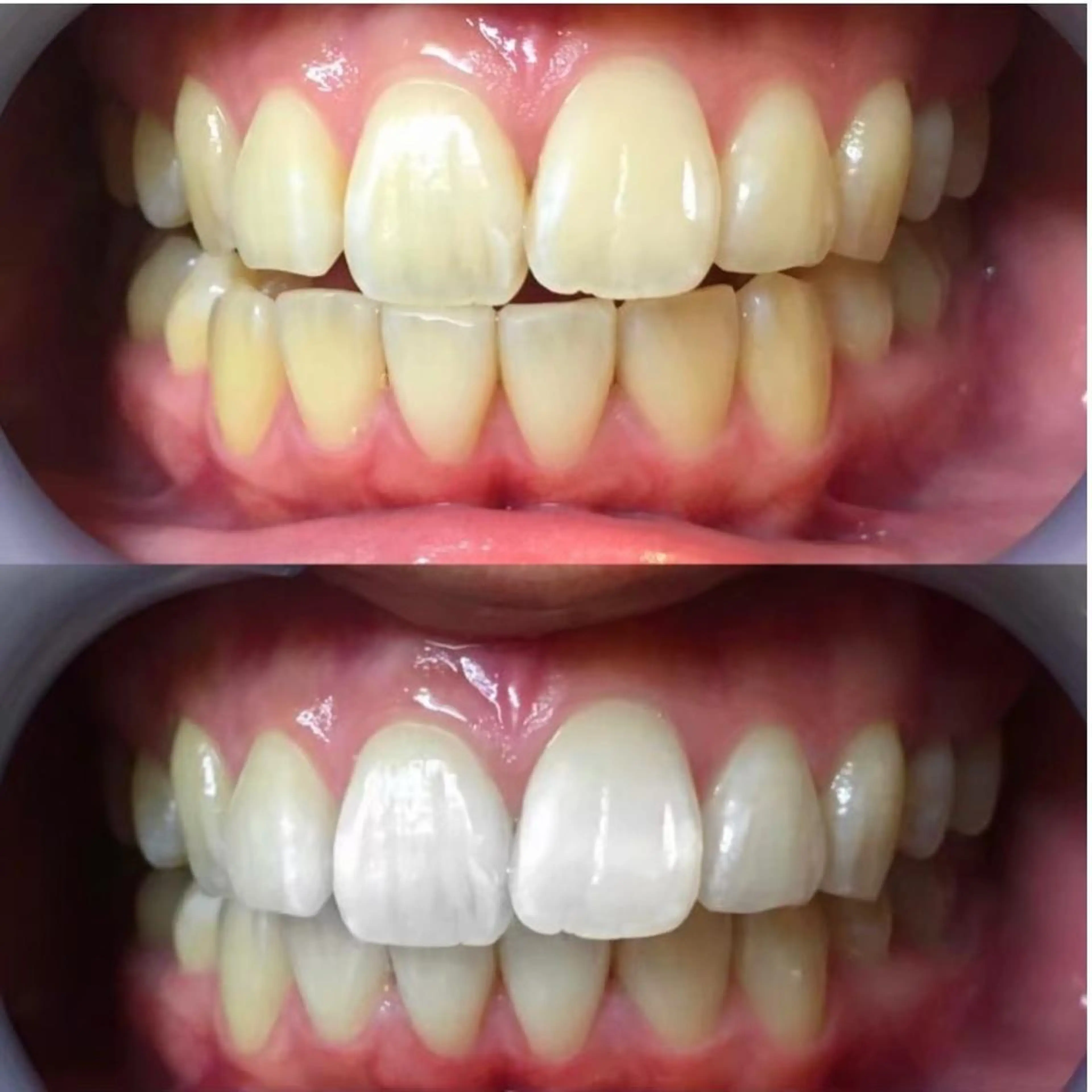 【早く白い歯へ🔥】8分照射×4回🦷✨早く白い歯にしたい方にオススメ☺️大人気のセルフホワイトニングで垢抜け💖の写真