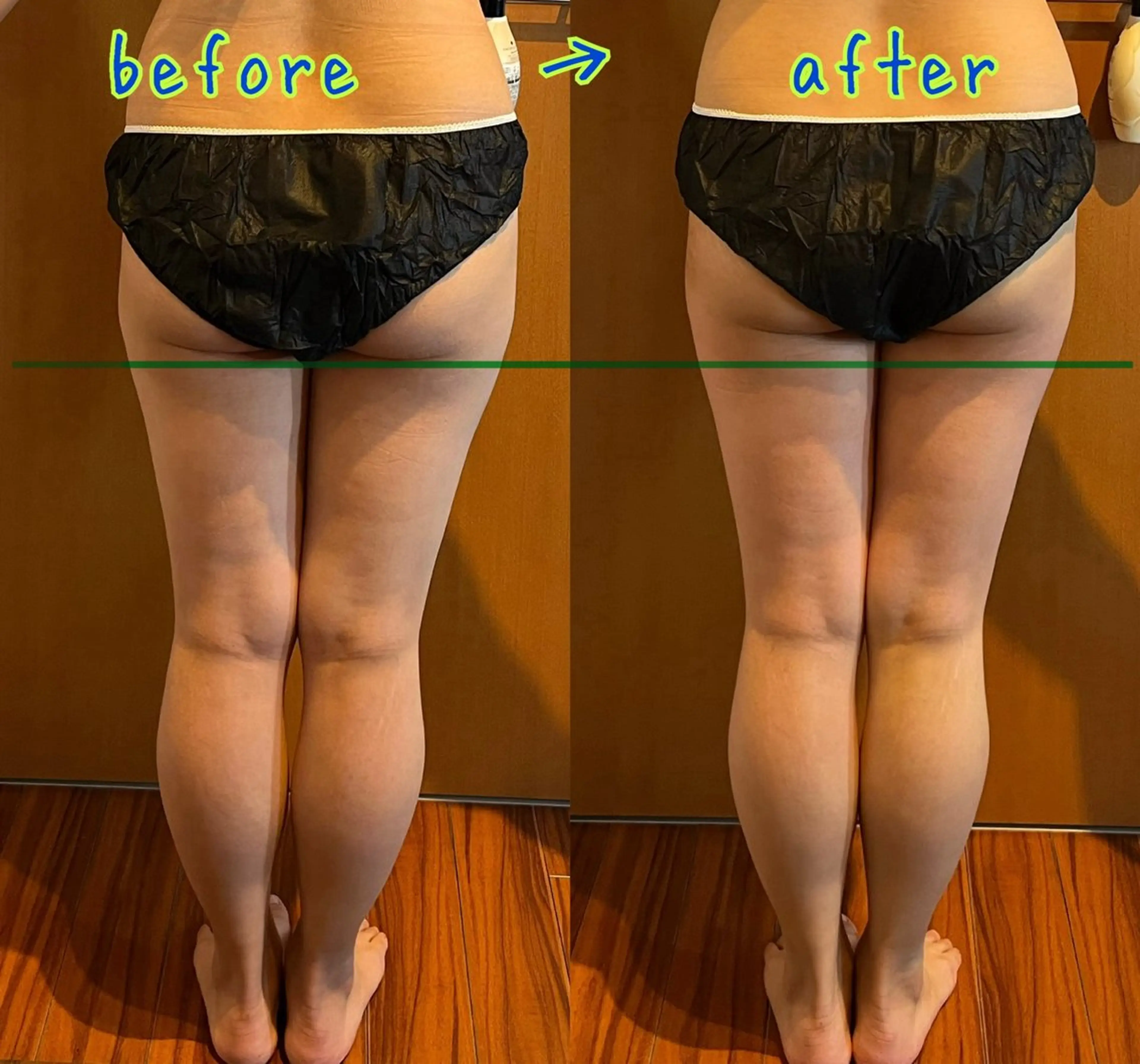 本気で痩せたい方限定！2部位120分【お腹、ヒップ、太もも、ふくらはぎ、背中、二の腕】EMS、キャビ、RFの写真