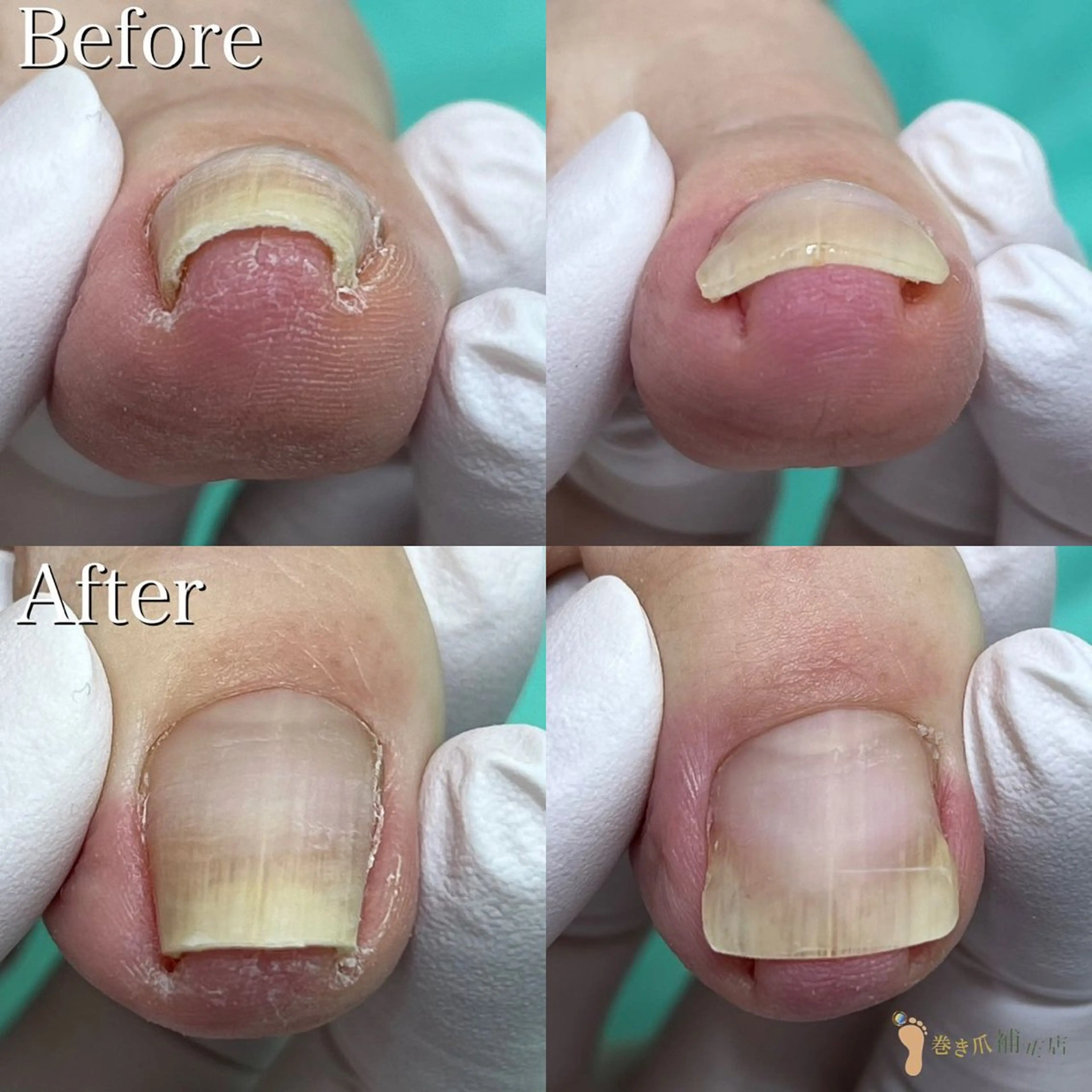 『巻き爪』朗報✨初回お試し料金1爪施術料がなんと🉐¥1000🉐の写真