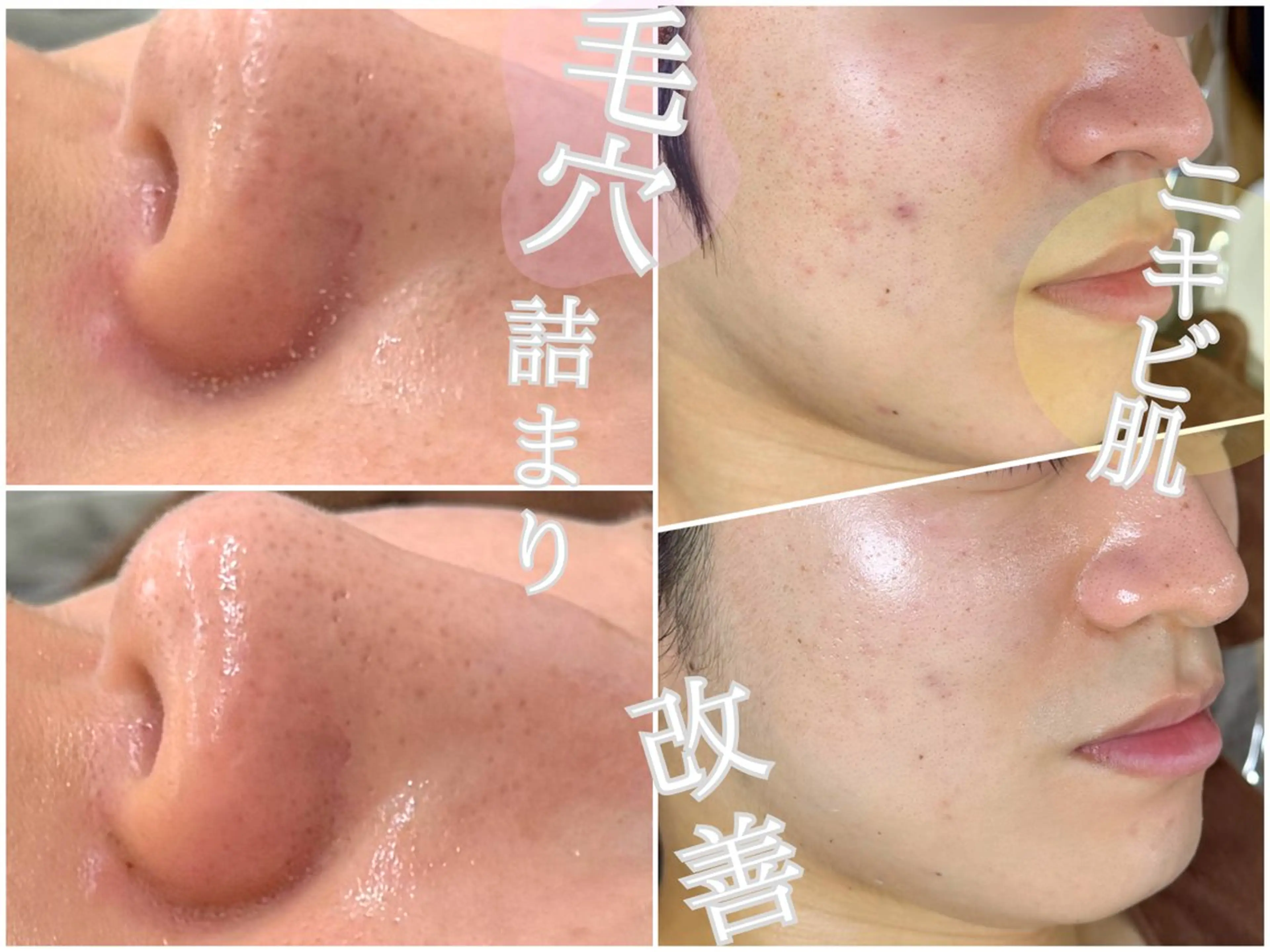 【ハーブピーリング/韓国ツヤ肌ピーリング】RelierBelle-ルリエベル-所属・肌質改善/肌育特化 プライベートサロンのエステ・リラクイメージ