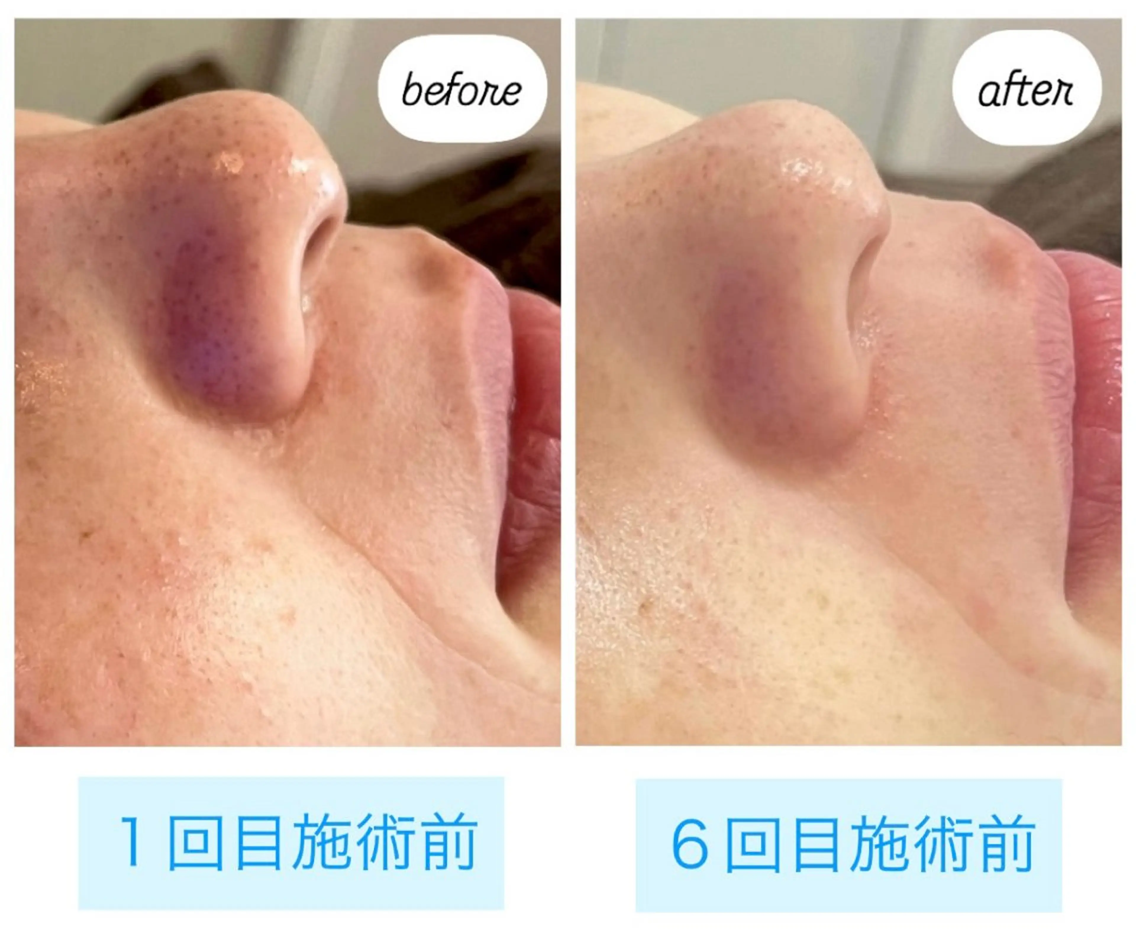 AY'S所属・倉敷/玉島/毛穴洗浄 古川碧のエステ・リラクイメージ