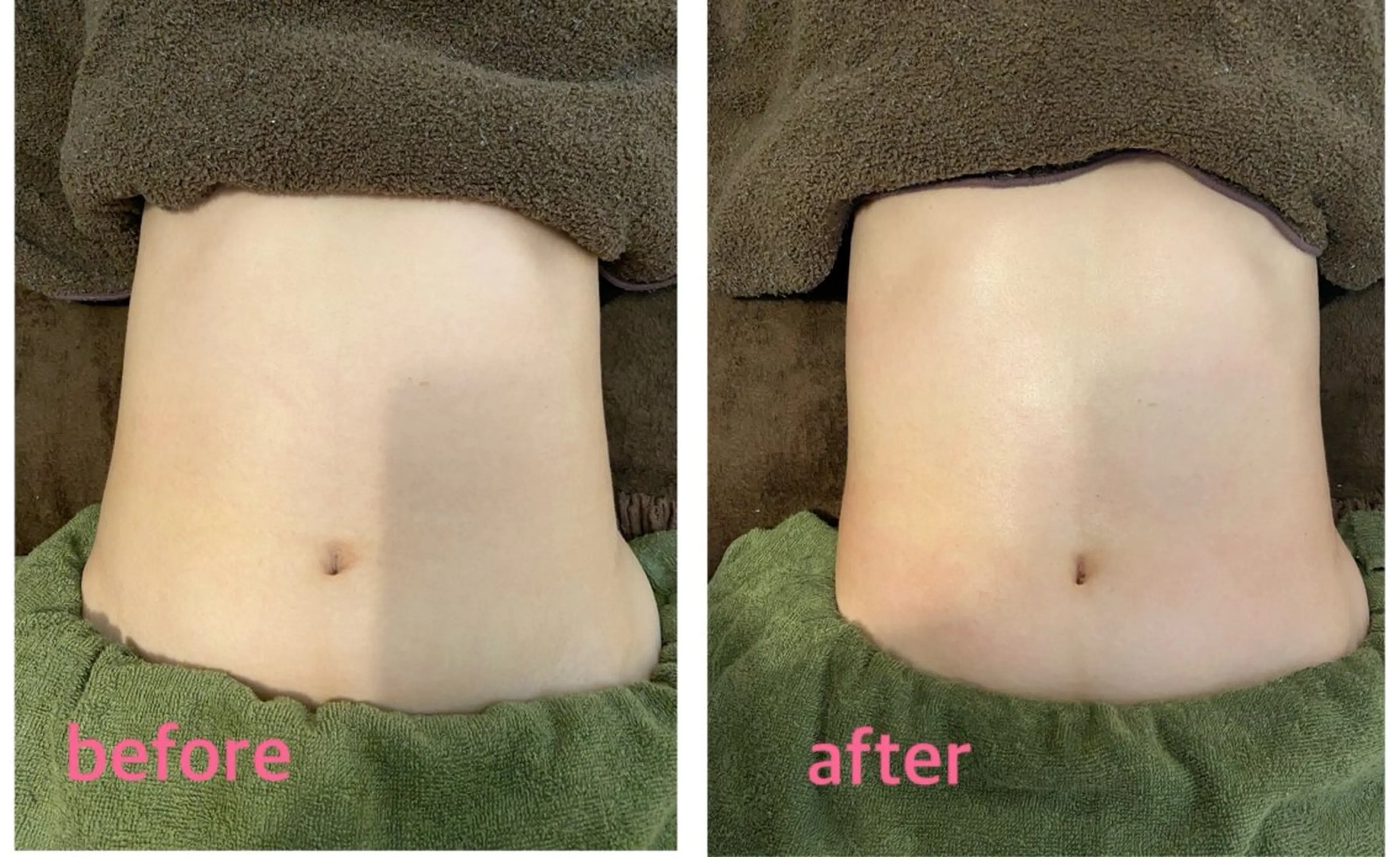 【免疫力アップ】ドライヘッドスパ45分＋腸リンパ45分 90分の写真