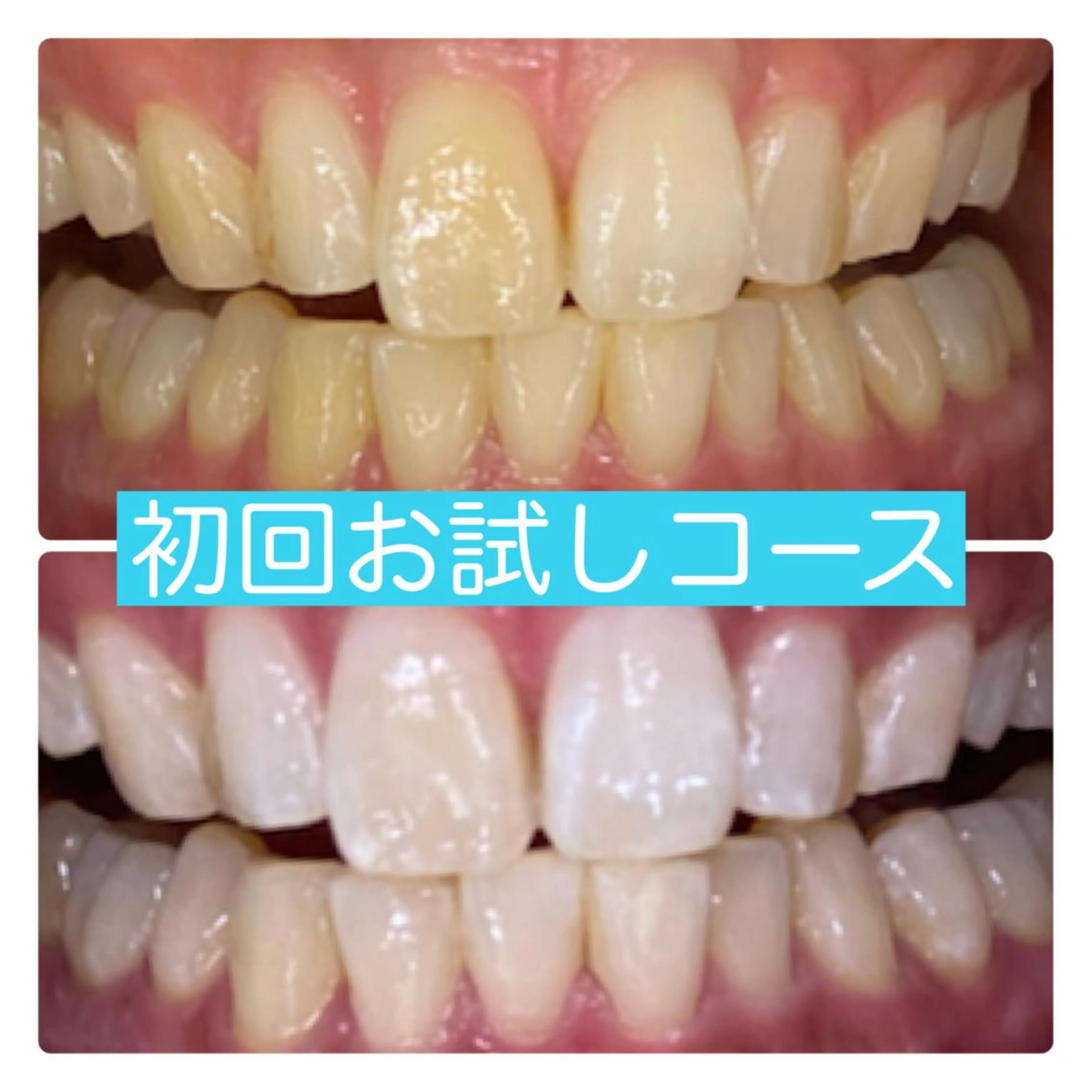 【期間限定】ホワイトニング30分照射🦷初回から白くなる💎平均5〜6トーンアップ⬆️最新マシーン使用❣️の写真