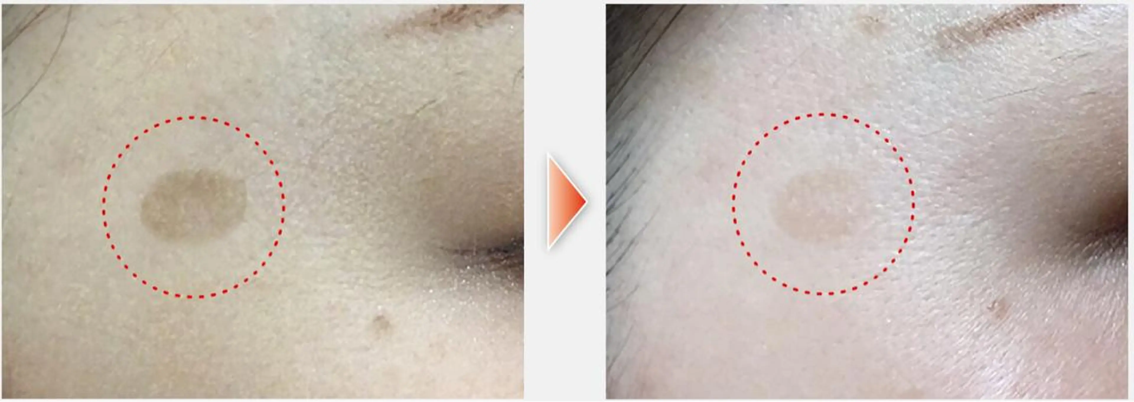 シミ改善トリートメントss(1​〜​2mm)シミ1ヶ所 ¥880の写真