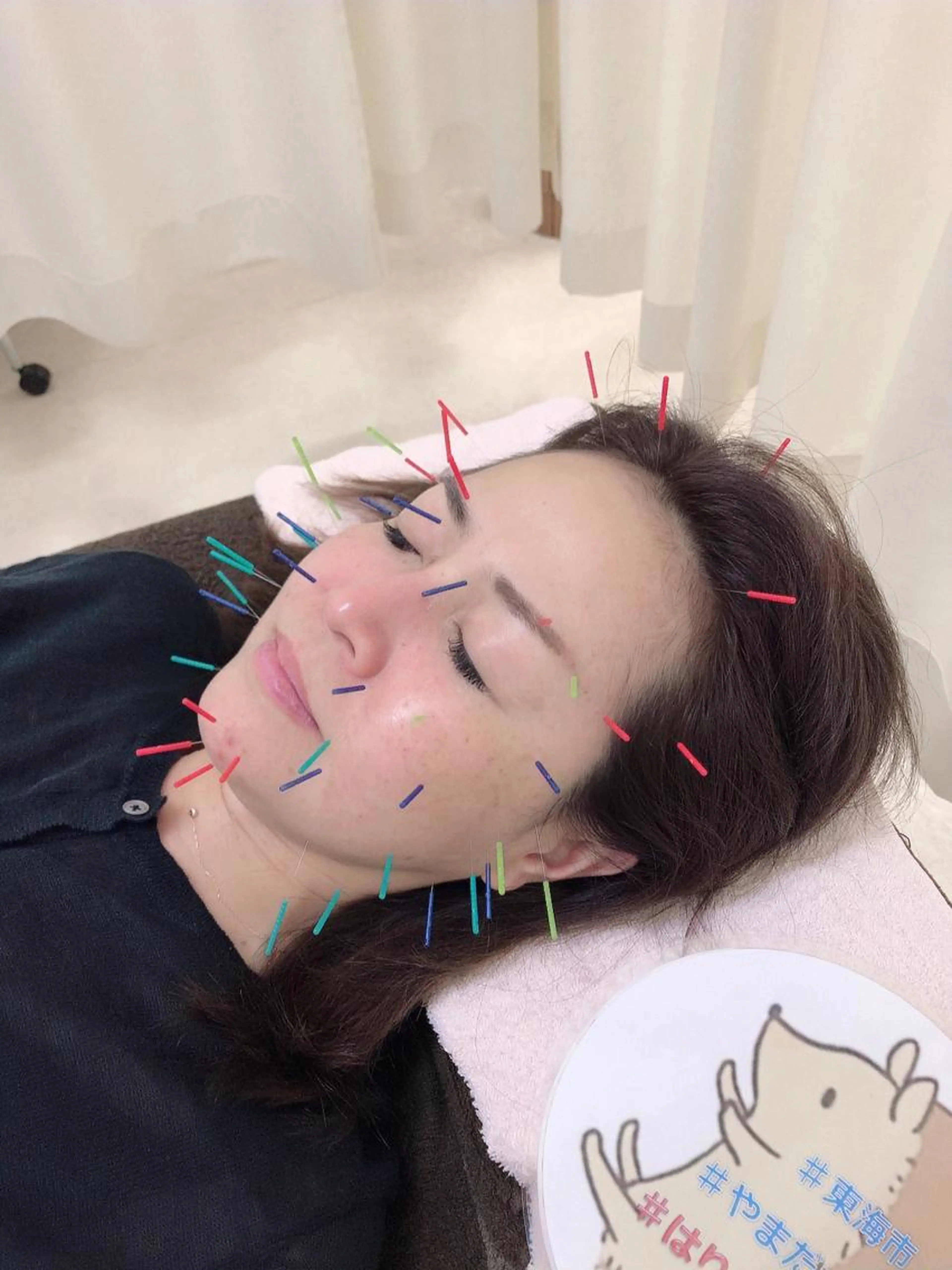 美容鍼ハリネズミコース（たっぷりコース）の写真