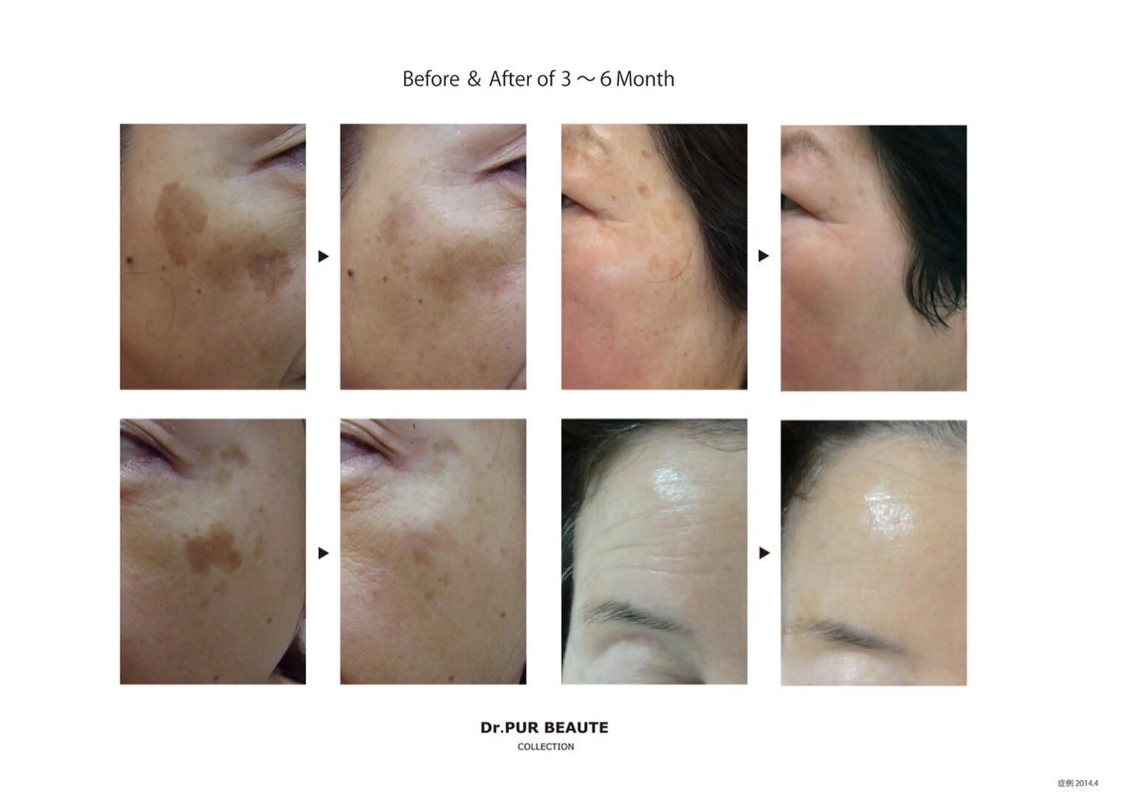 初回価格【ピュールボーテフェイシャル】の写真