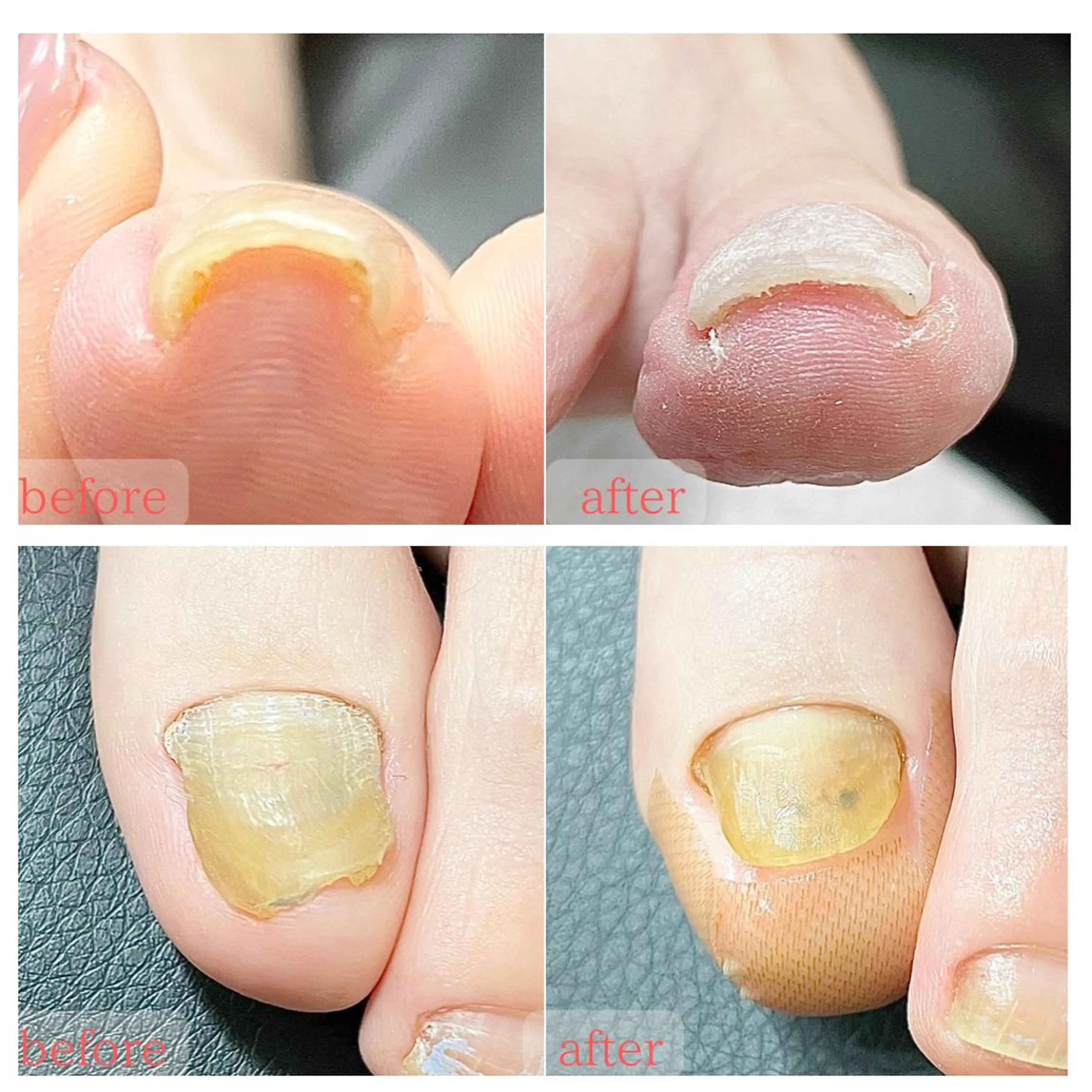 ネイル 深爪・巻き爪 専門サンセリテのネイルデザイン