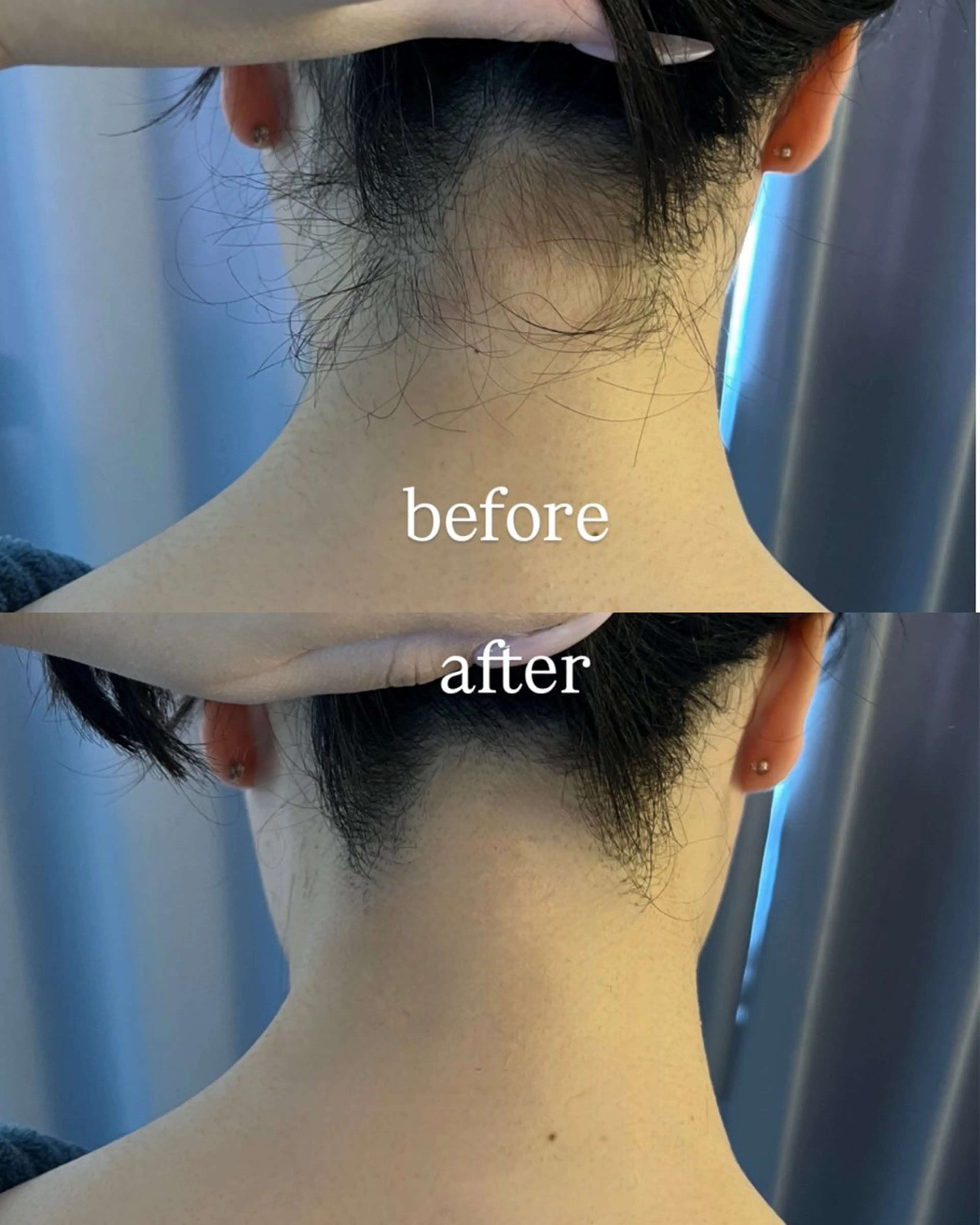脱毛 うなじ脱毛/美肌脱毛 LABELのエステ・リラクイメージ