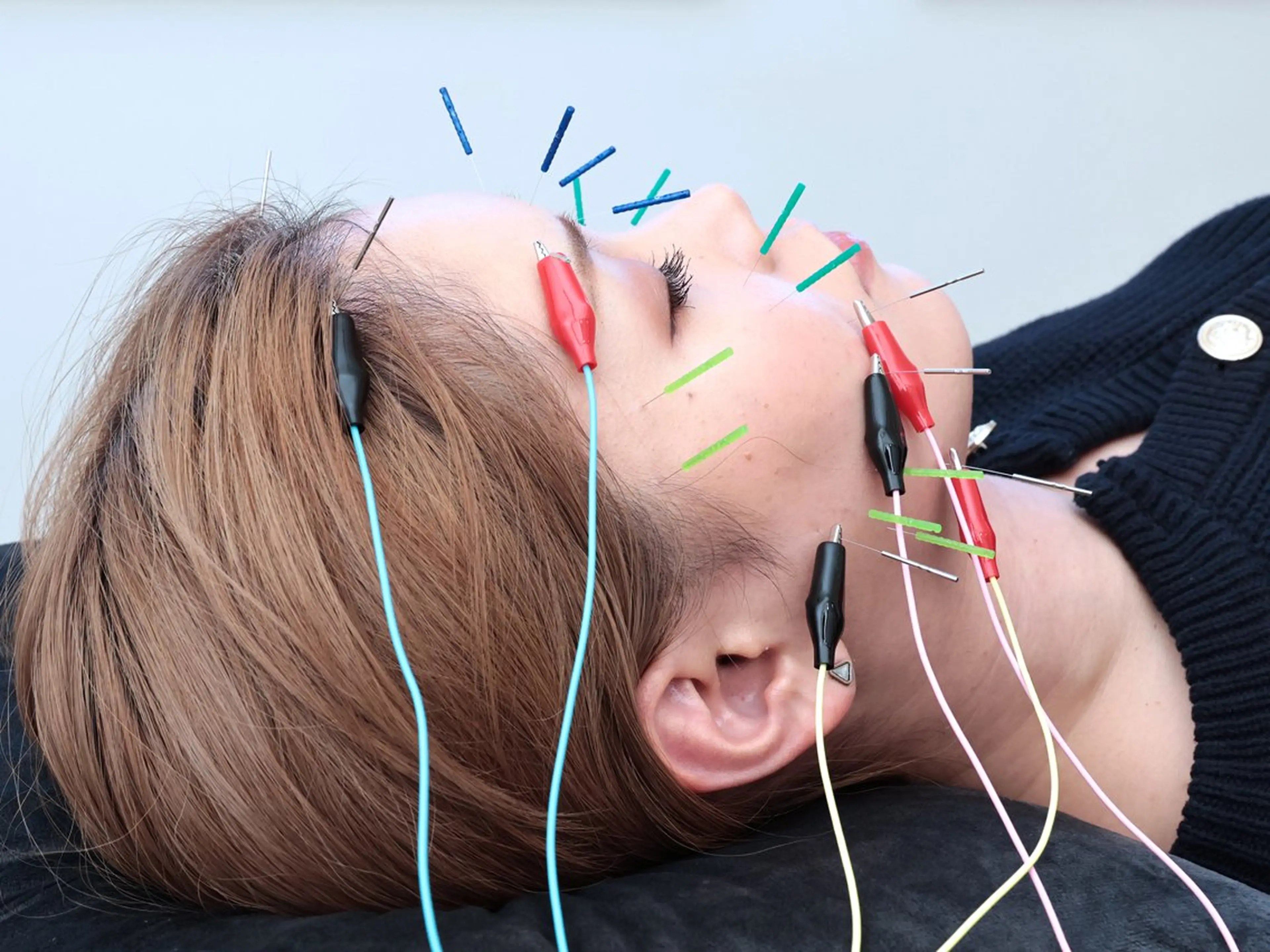 《お試し美容鍼》小顔/えら解消/むくみ/たるみ/肌荒れ改善　美容鍼、鍼を受けたことがない方にオススメ✨の写真