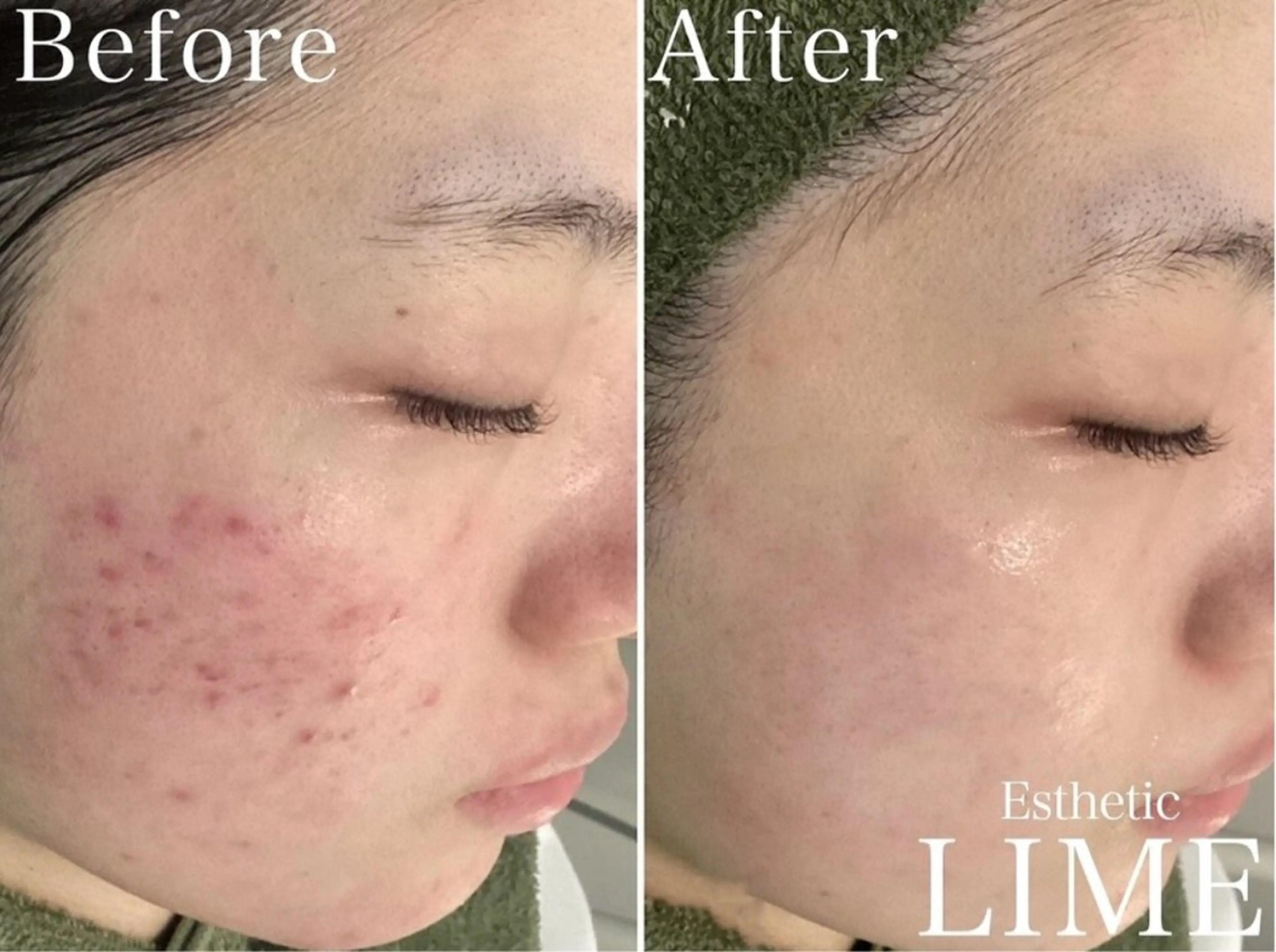 LIME横浜所属・ハーブピーリング🌿 韓国肌管理 Rionのエステ・リラクイメージ