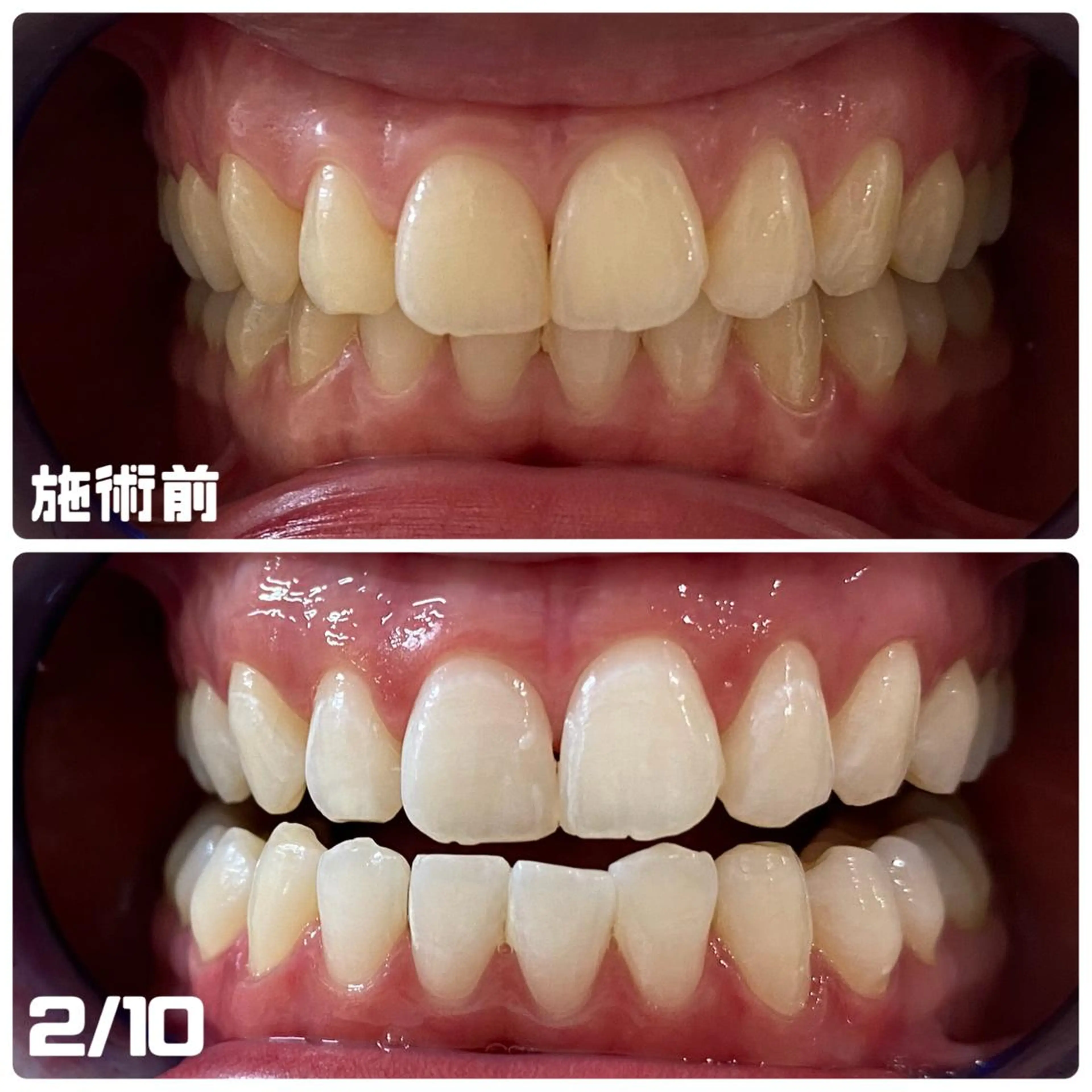 White Berry SELF BEAUTY SALON所属・セルフホワイトニング 🦷口元垢抜け✨のその他イメージ