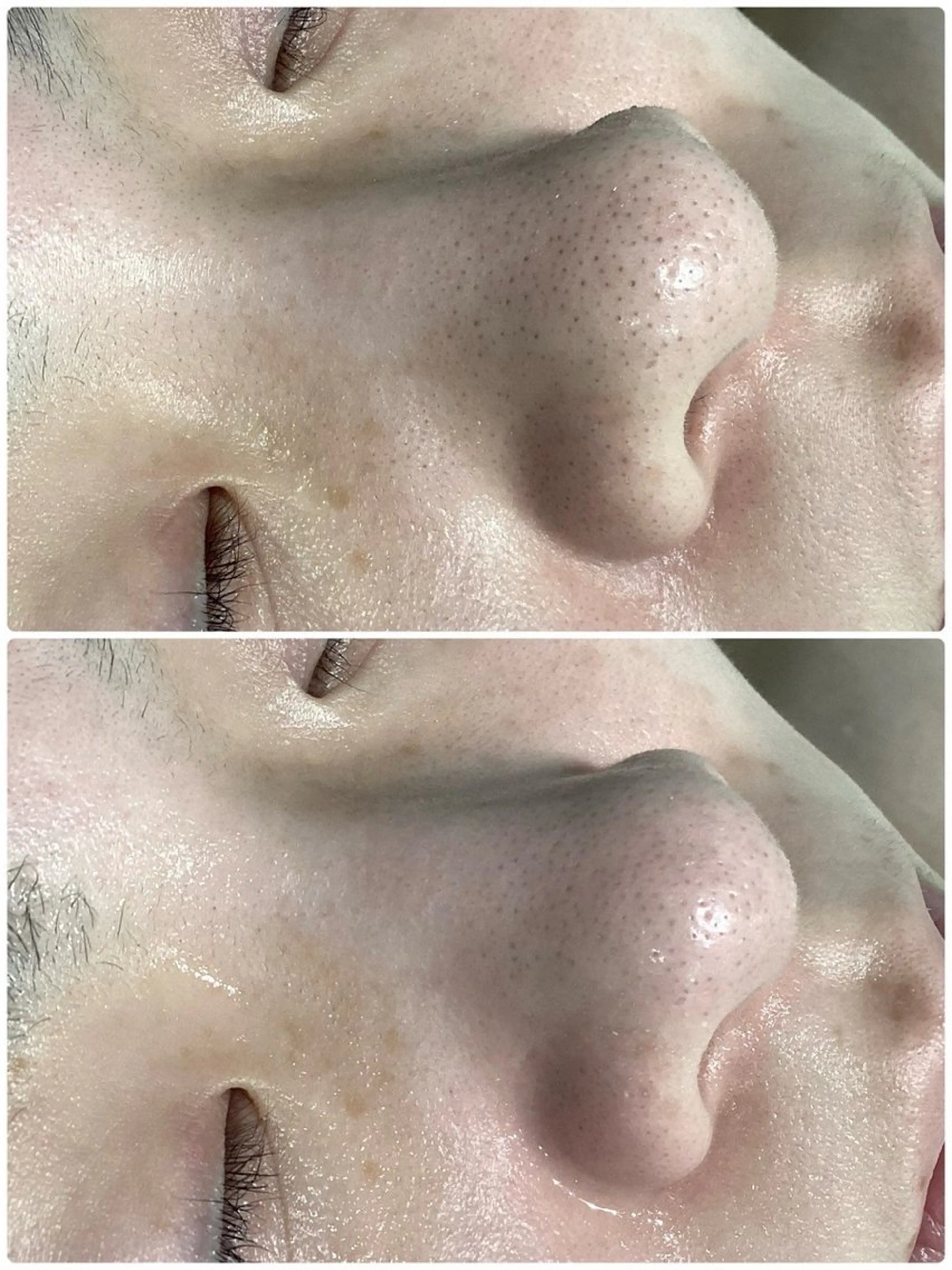 毛穴洗浄＋ハーブピーリング＋光フォトの写真