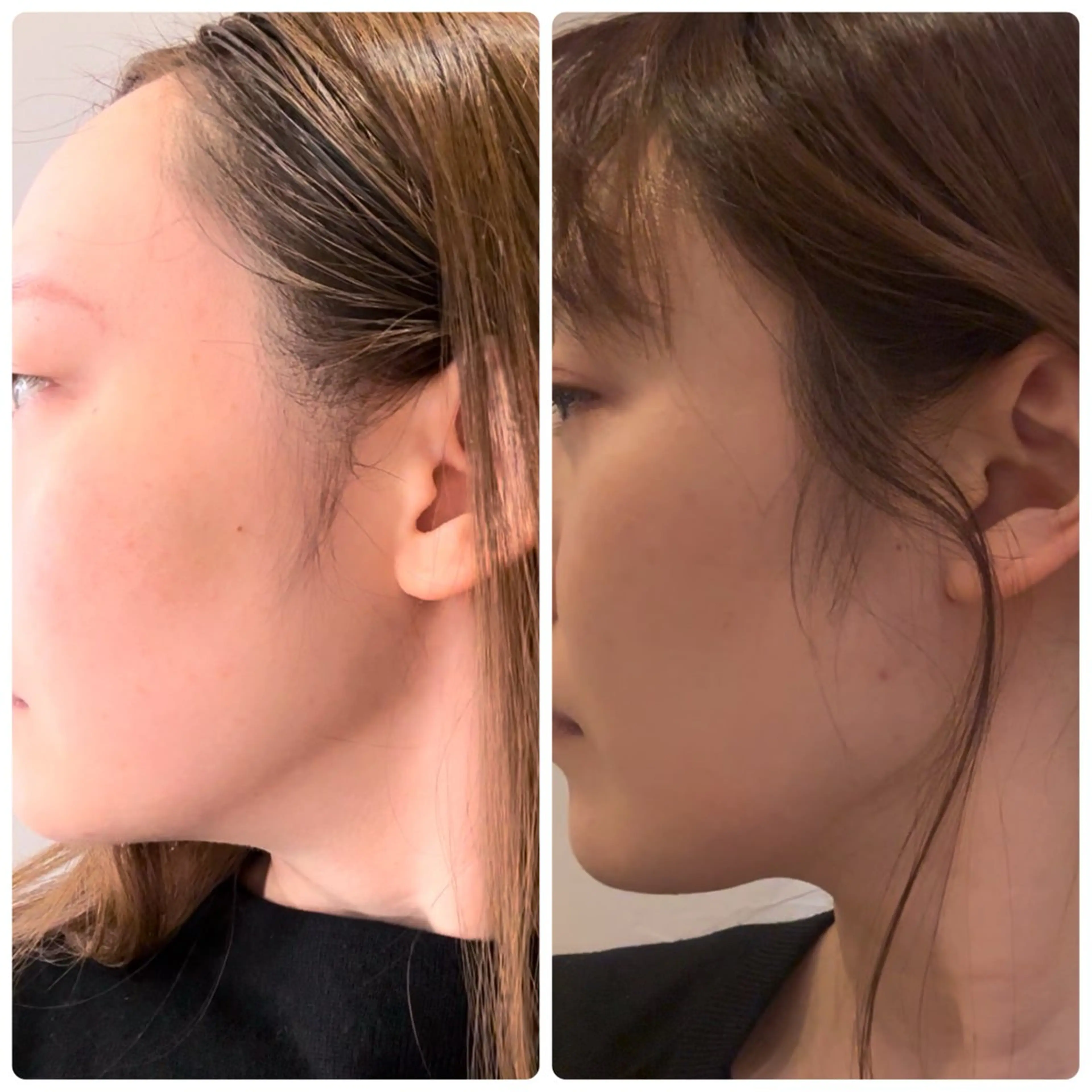 【二重アゴ】話題のレモンbottle🍋✨流行りの脂肪溶かし💓の写真