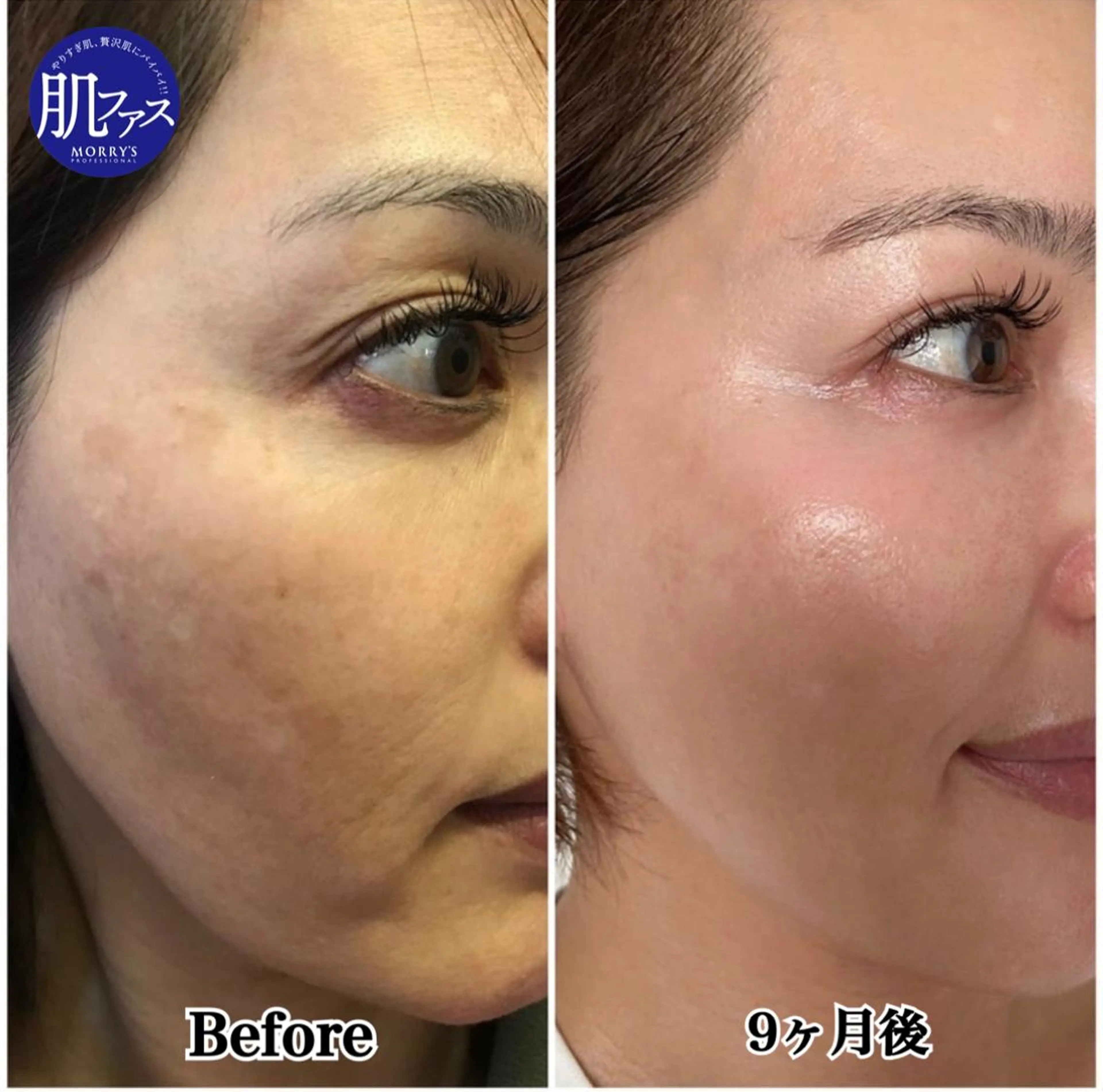 【憧れのノーファンデ肌 #肌ファス】本気で始める肌改善プログラム❗️全てのお肌悩みに✨7日間の肌ファスティングマスク付きの写真