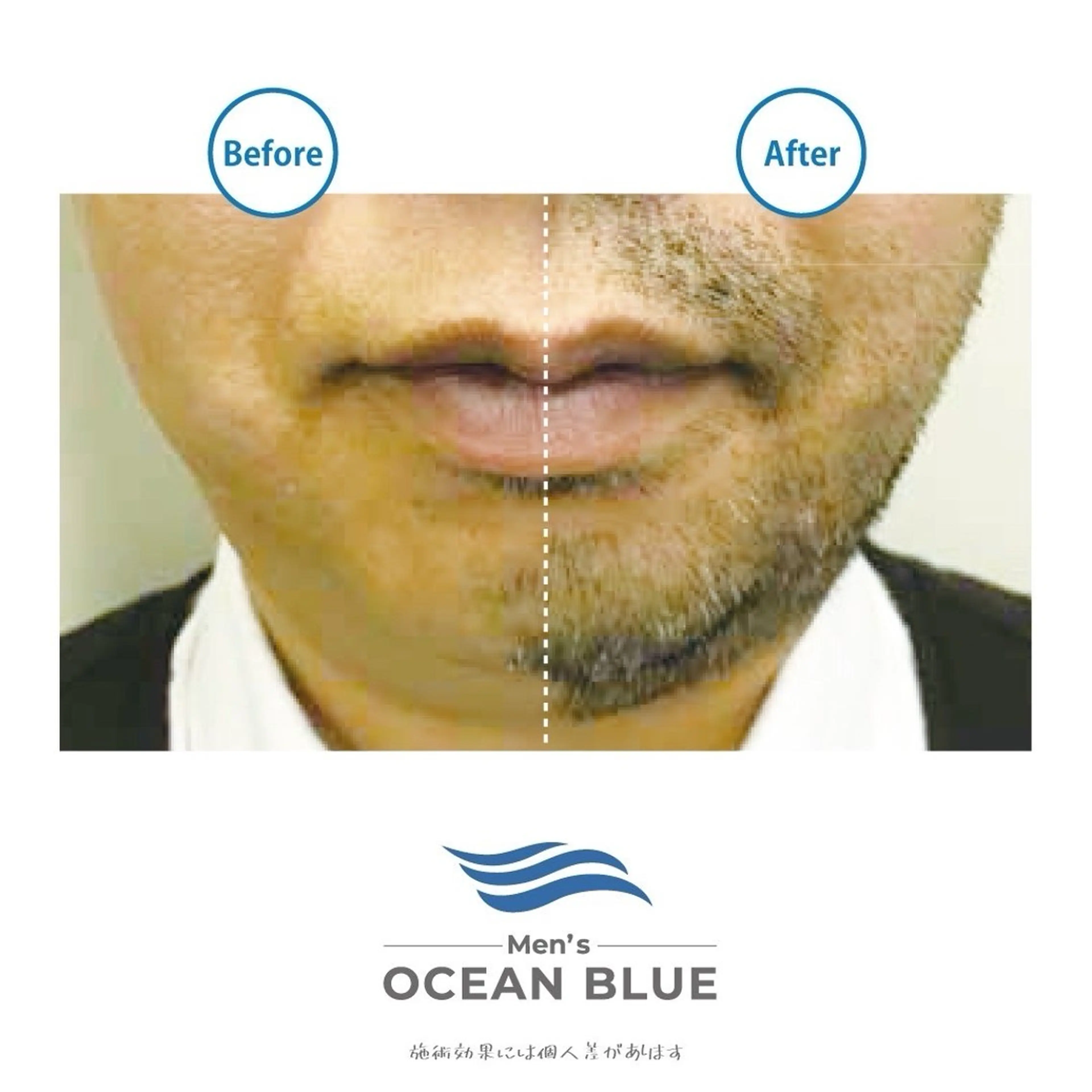 メンズヒゲ脱毛の写真