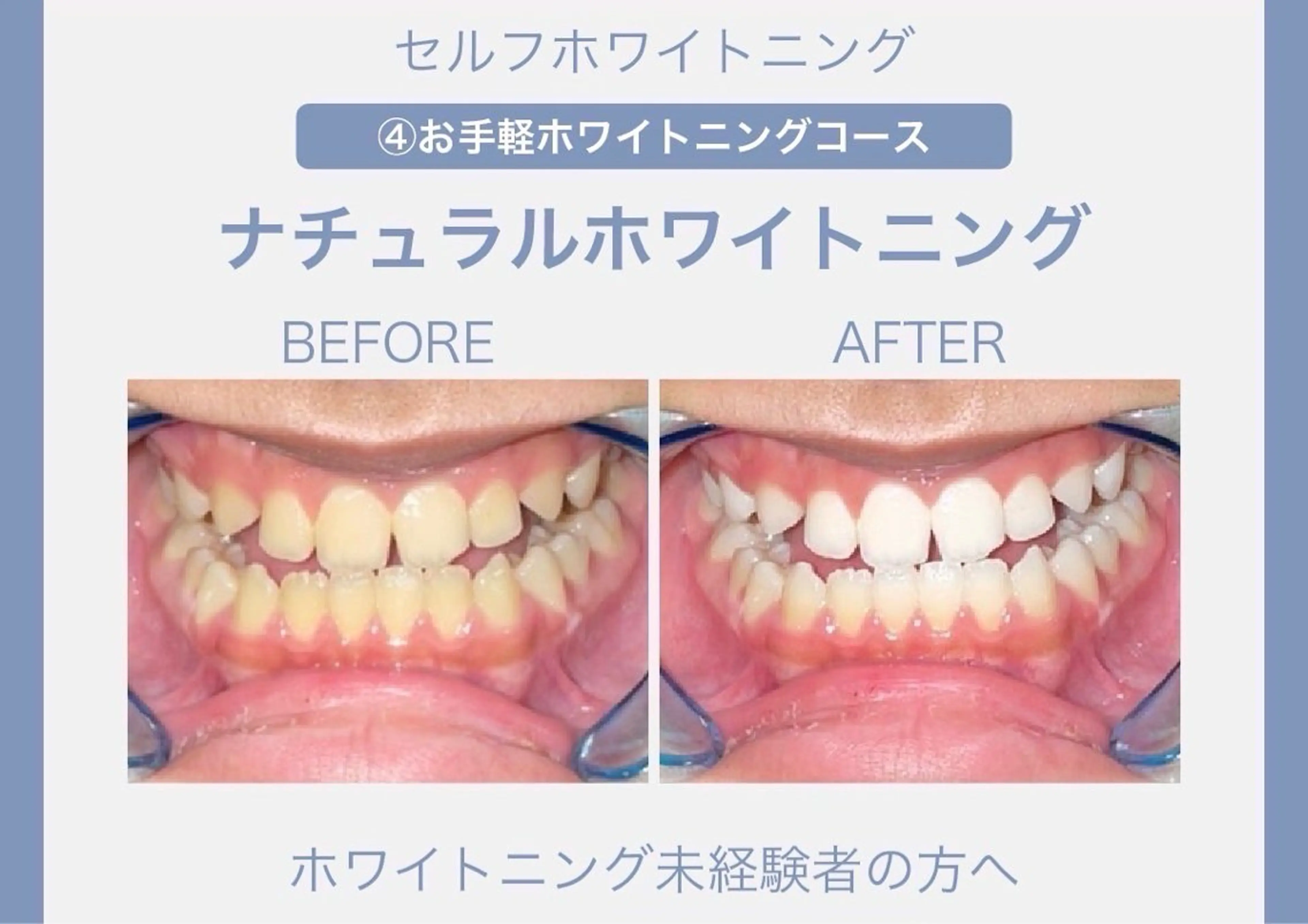 【自然な白さのホワイトニング】歯本来のピカピカの白さを目指していきます😁〈30分照射コース〉の写真