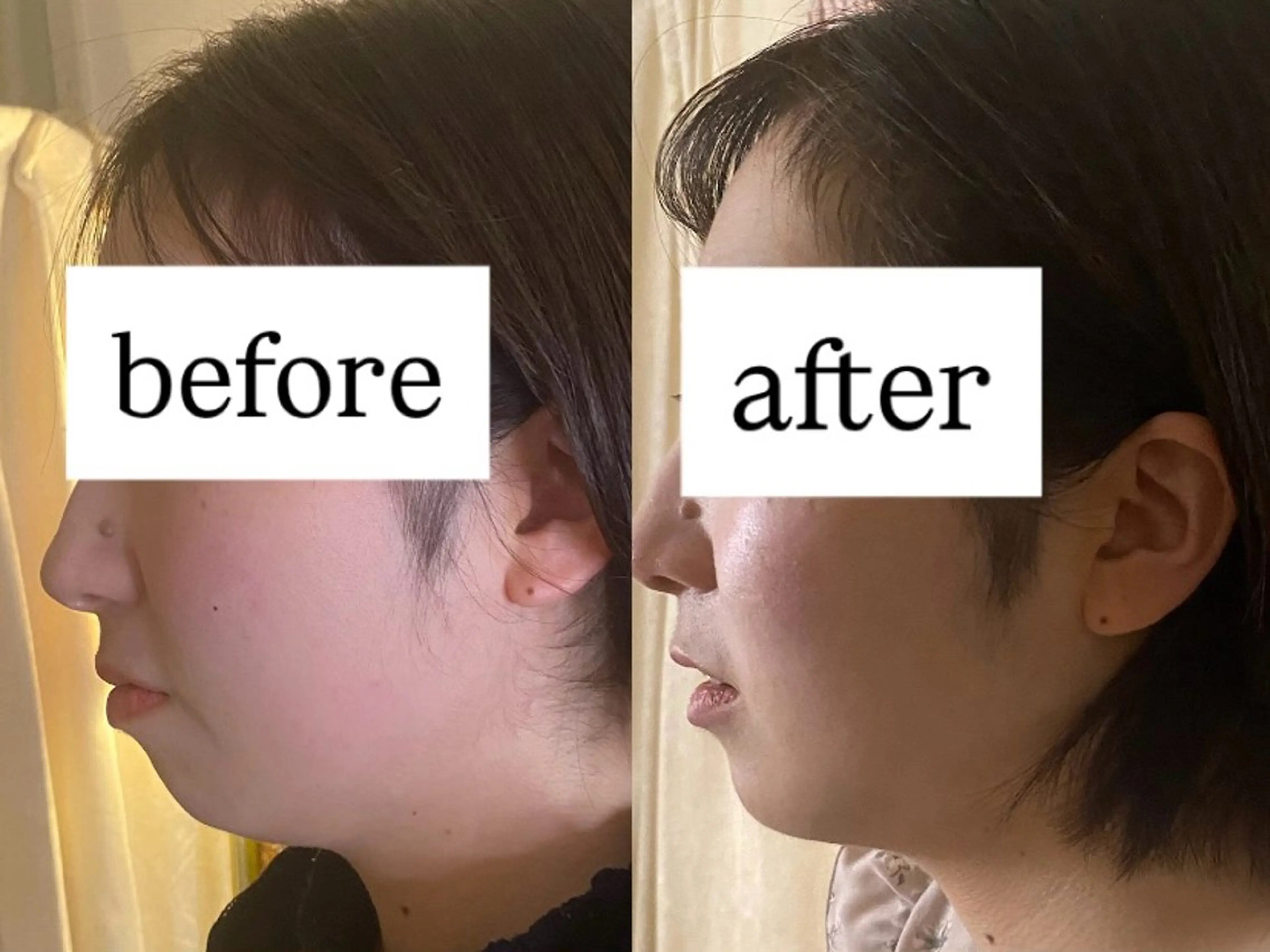 まずはお試し🍀【美容鍼】小顔/むくみ/たるみ/眼精疲労/脳疲労の写真