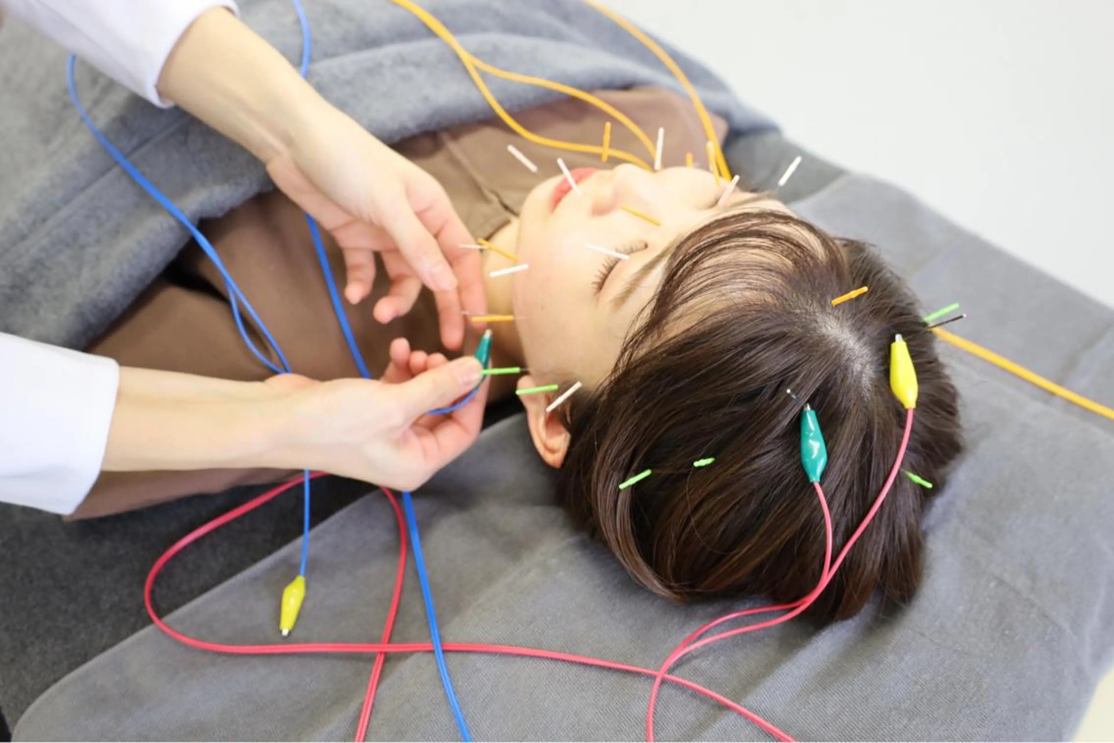 【リフトアップ】コラーゲンアップ再生美容鍼（通電付き）＋ヘッドマッサージ付きの写真