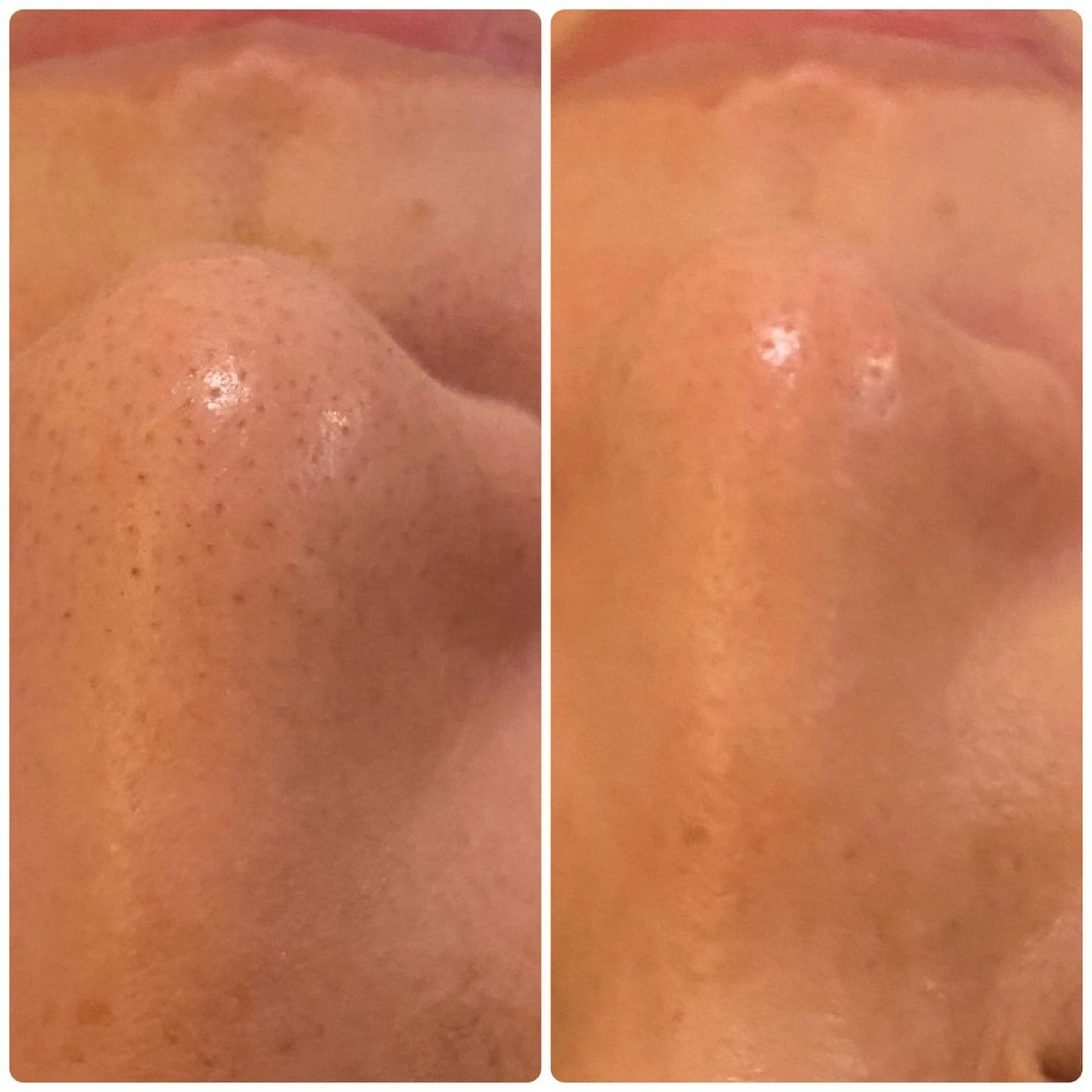 ★ハイドロスプラッシュ毛穴洗浄コース★の写真