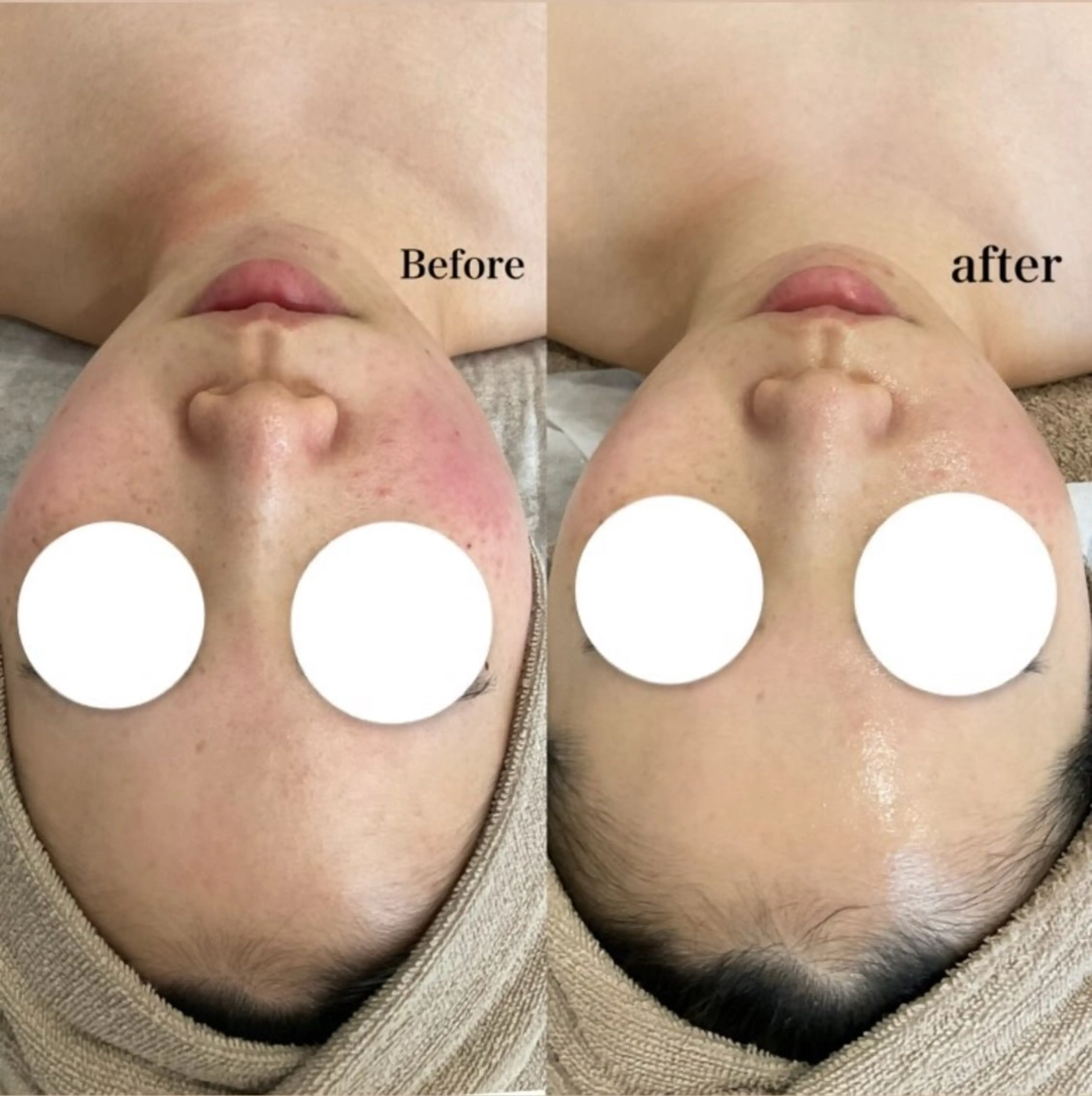 韓国式ピーリングの写真