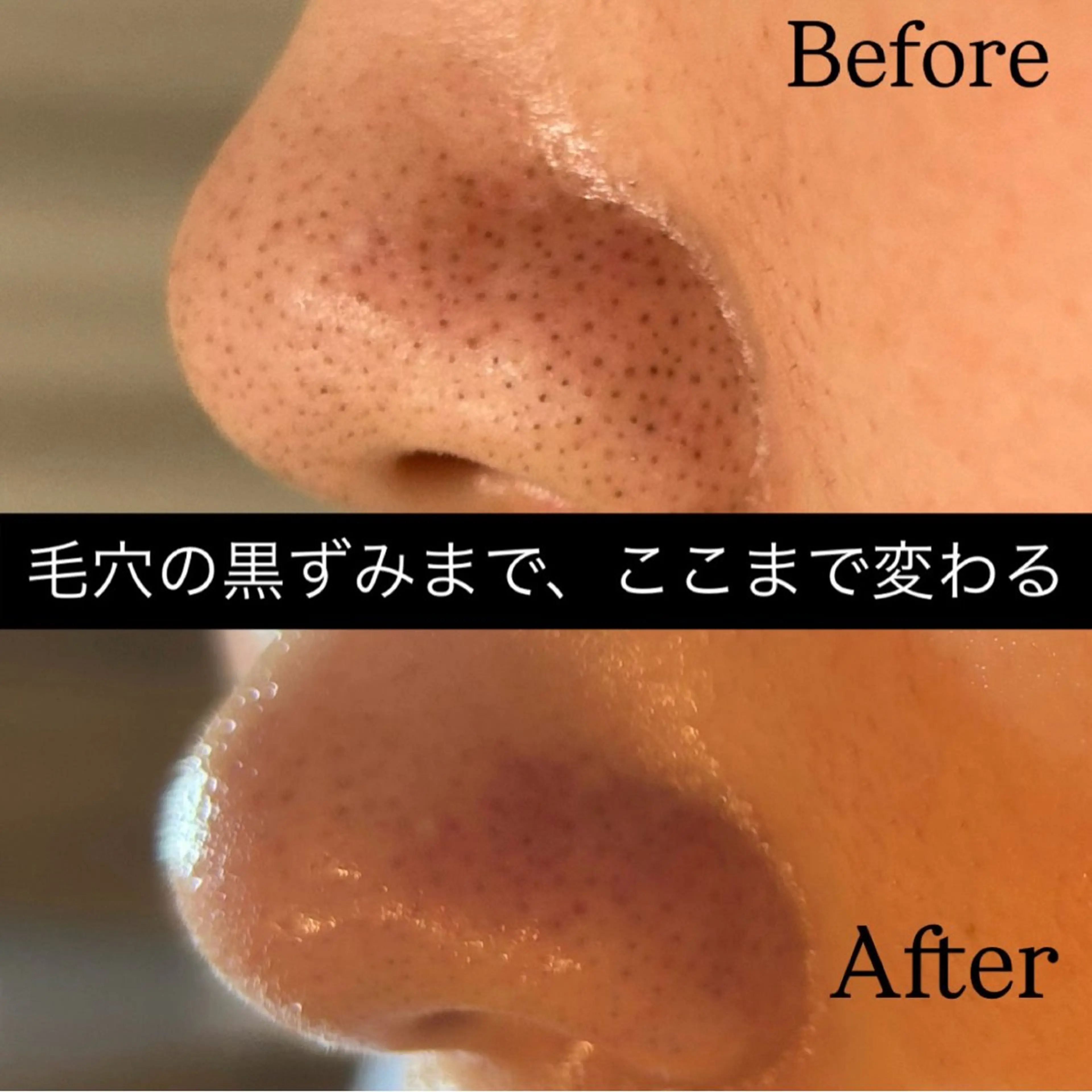 【3月限定】毛穴レス集中ケア＋専用ホームケア付き早くお悩みを解決！✨¥16500の写真