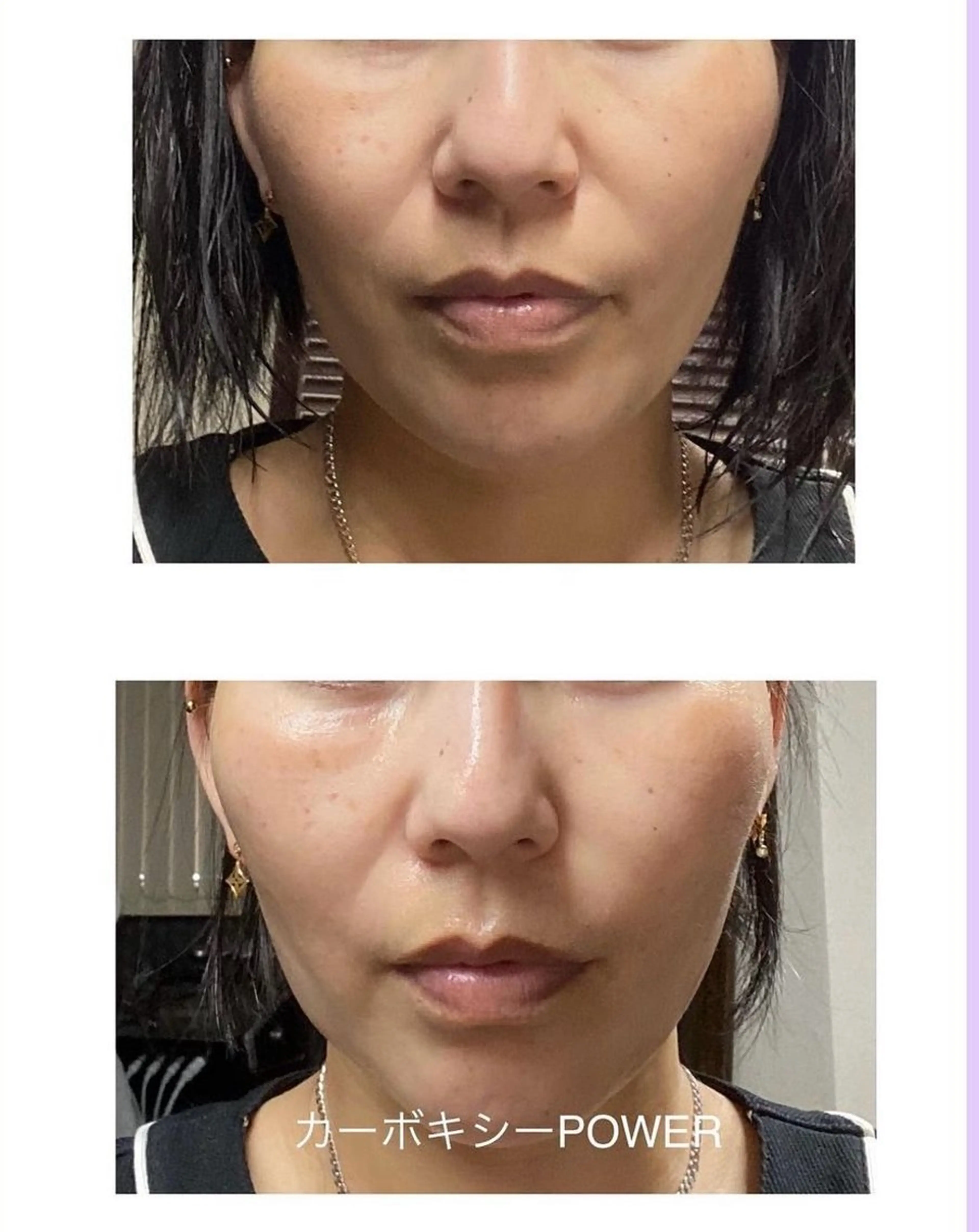 カーボキシー炭酸パックの写真