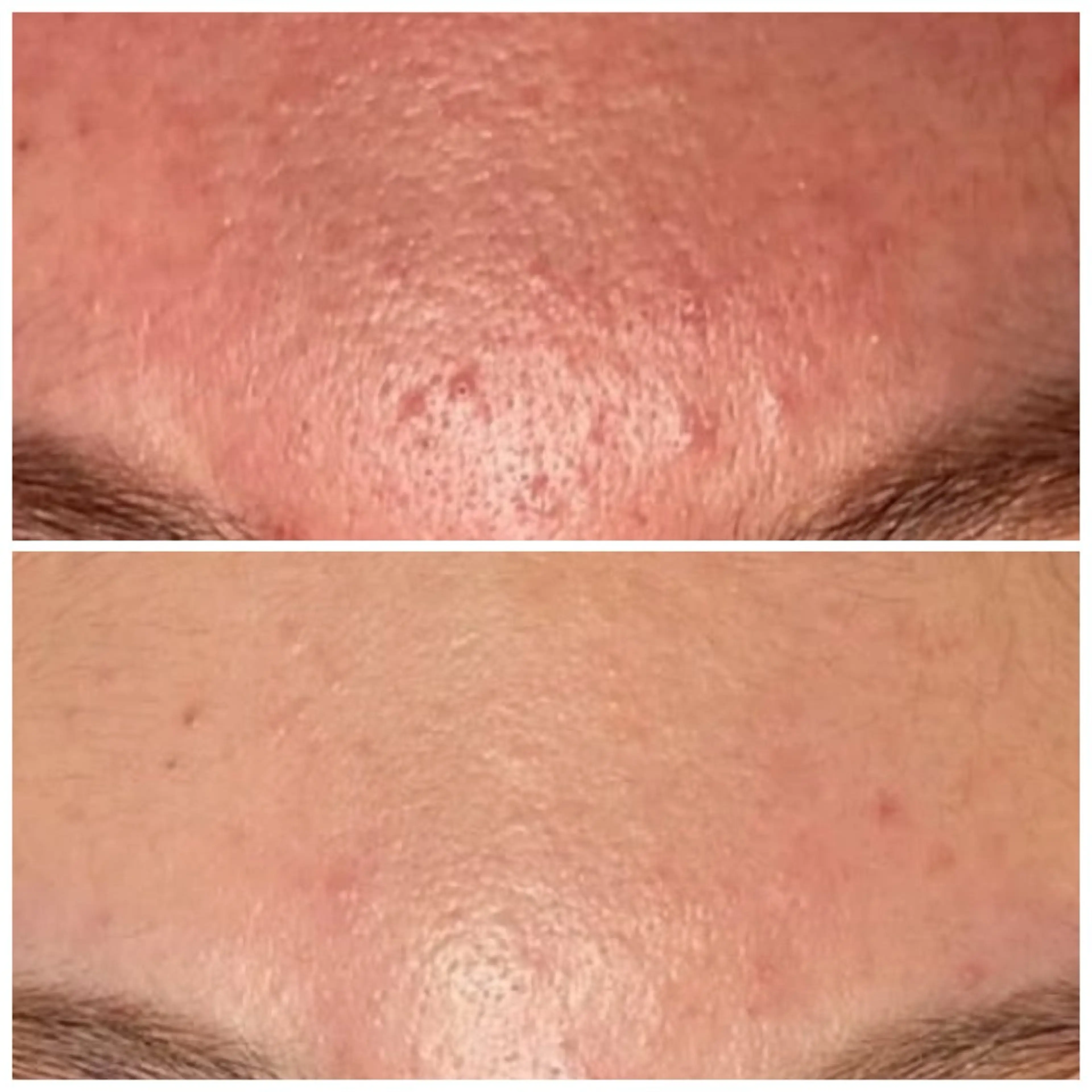 ハーブピーリング re:proのエステ・リラクイメージ