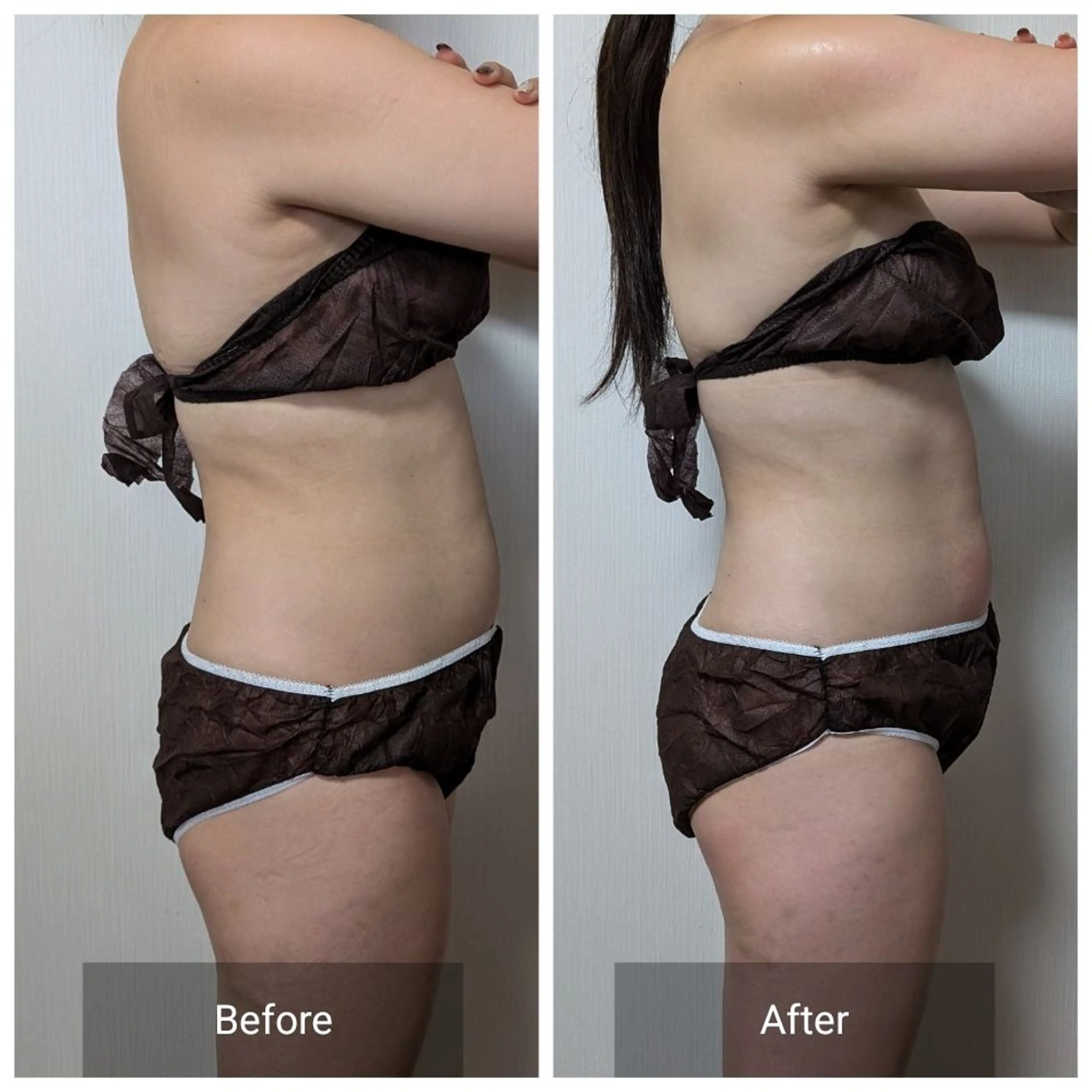 上半身すっきりセルライトケアコース40分エステの写真