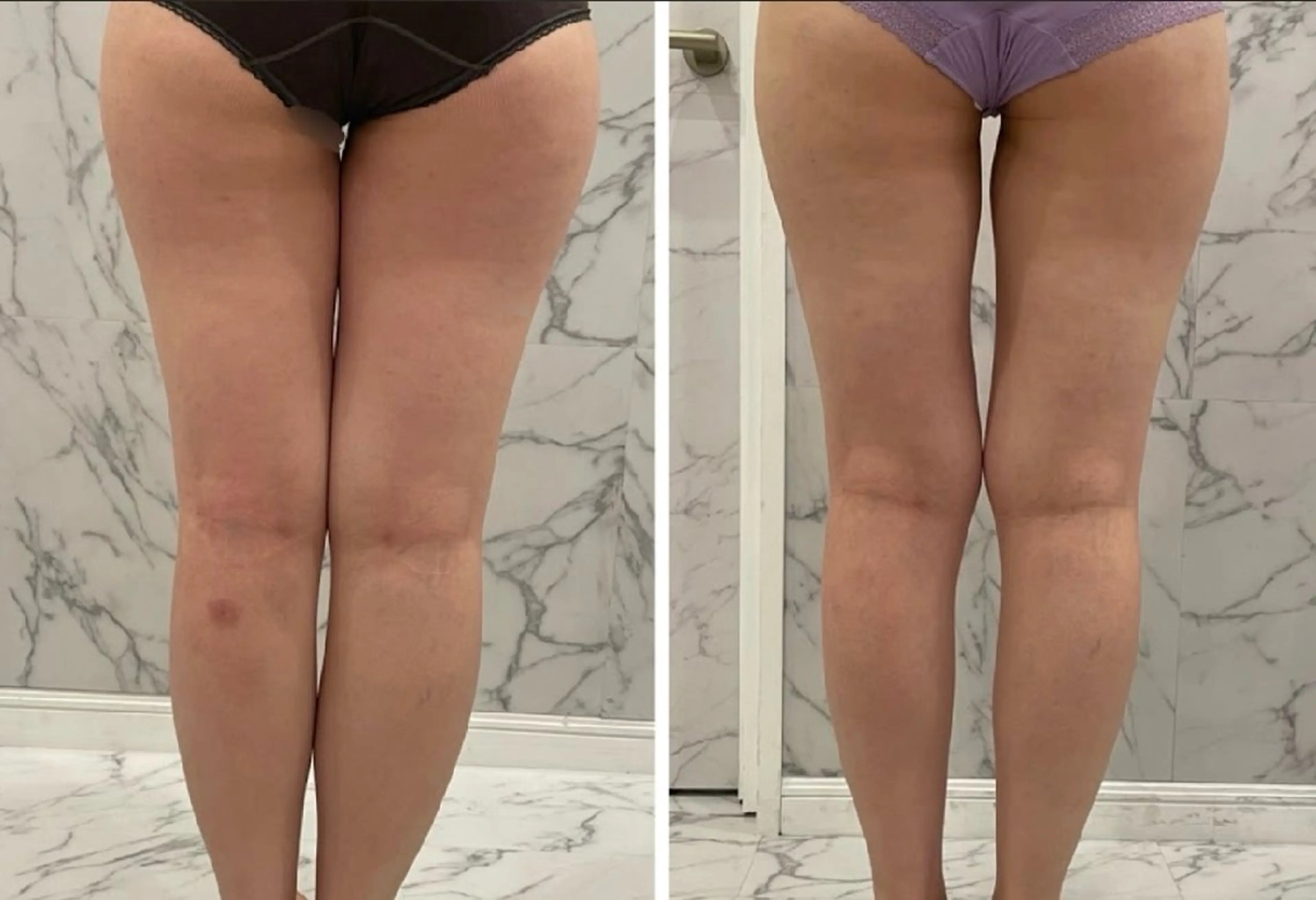 全身筋膜コース《痩身》　一度で効果を体験したい方にオススメ！お身体引き締めと痩せやすい身体作りを実現◎の写真