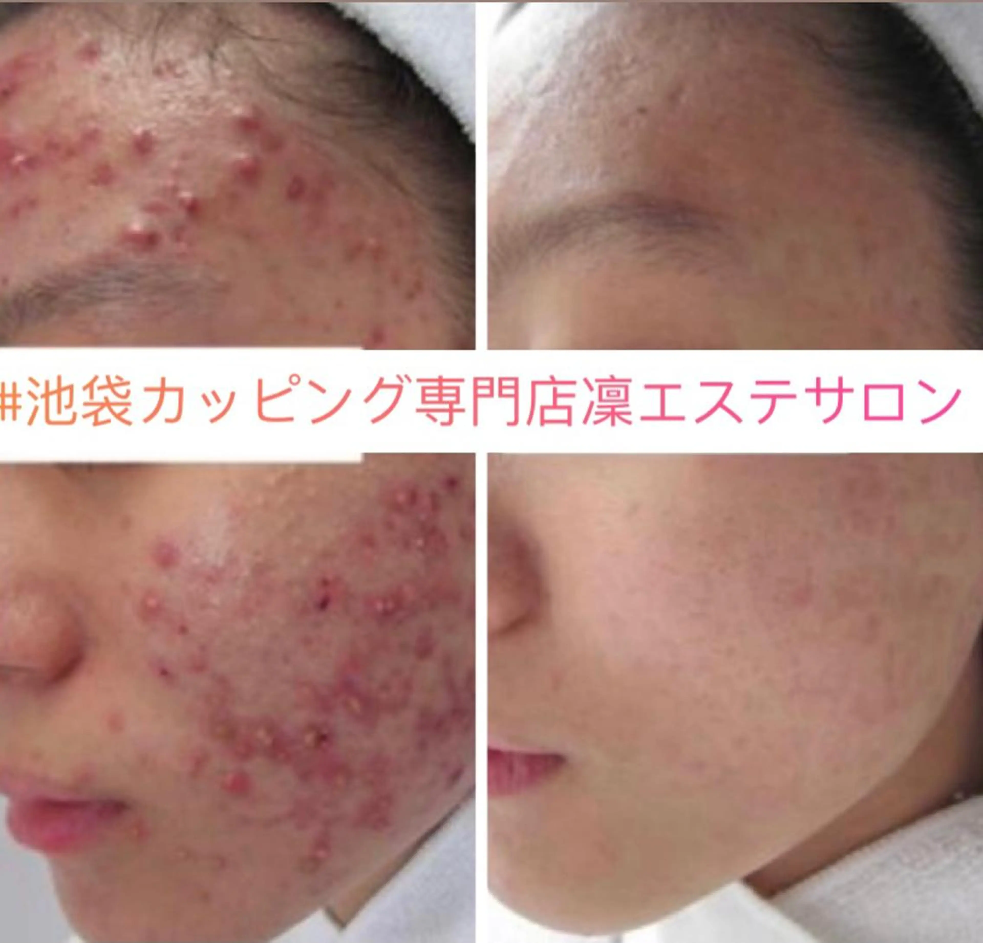 【実感度No.1★】大人の吹き出物・アクネ菌改善コースの写真