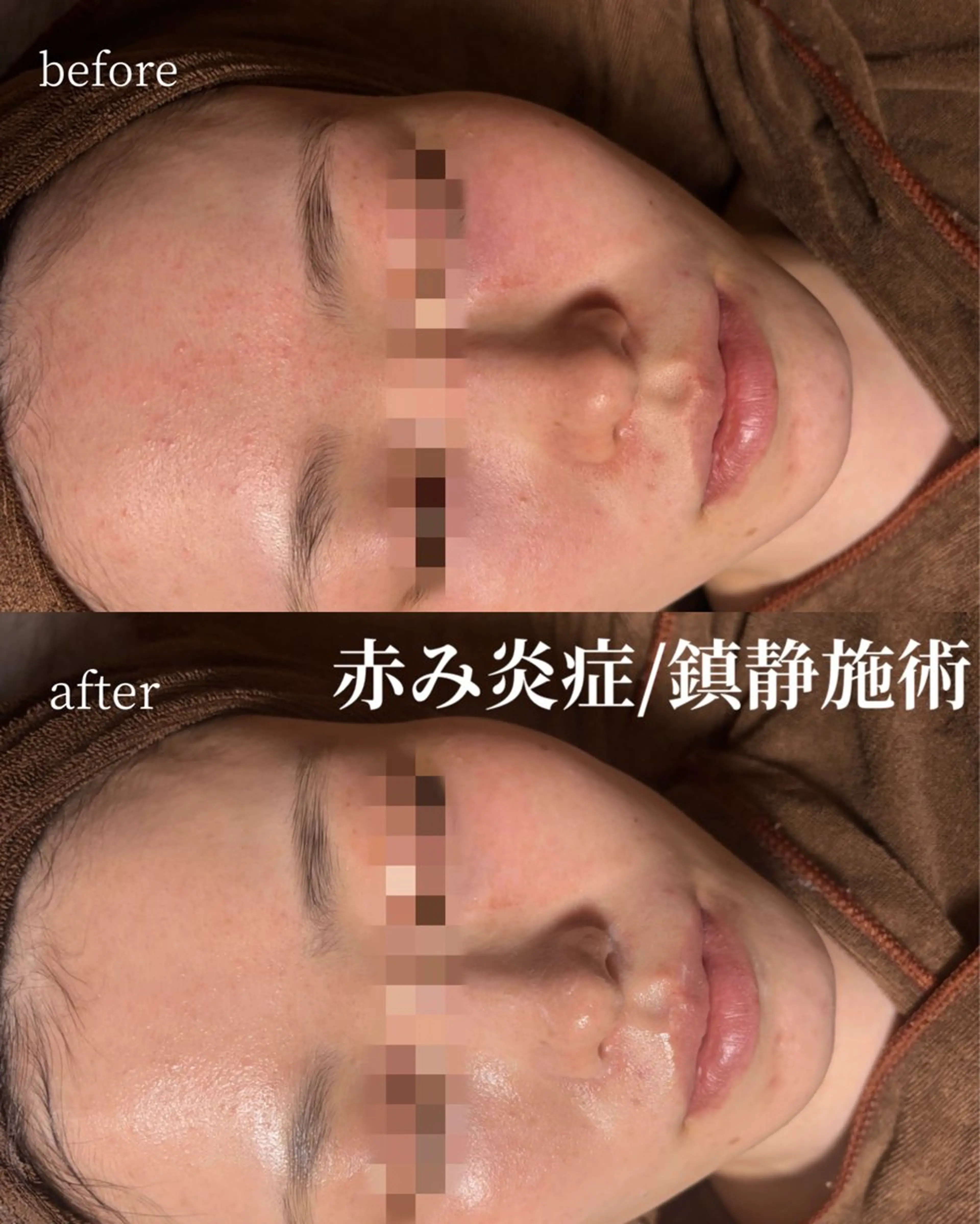 エステ HINANO矢場町店【ヒナノ】所属・脱毛/肌改善🌿 HINANO 村田のエステ・リラクイメージ