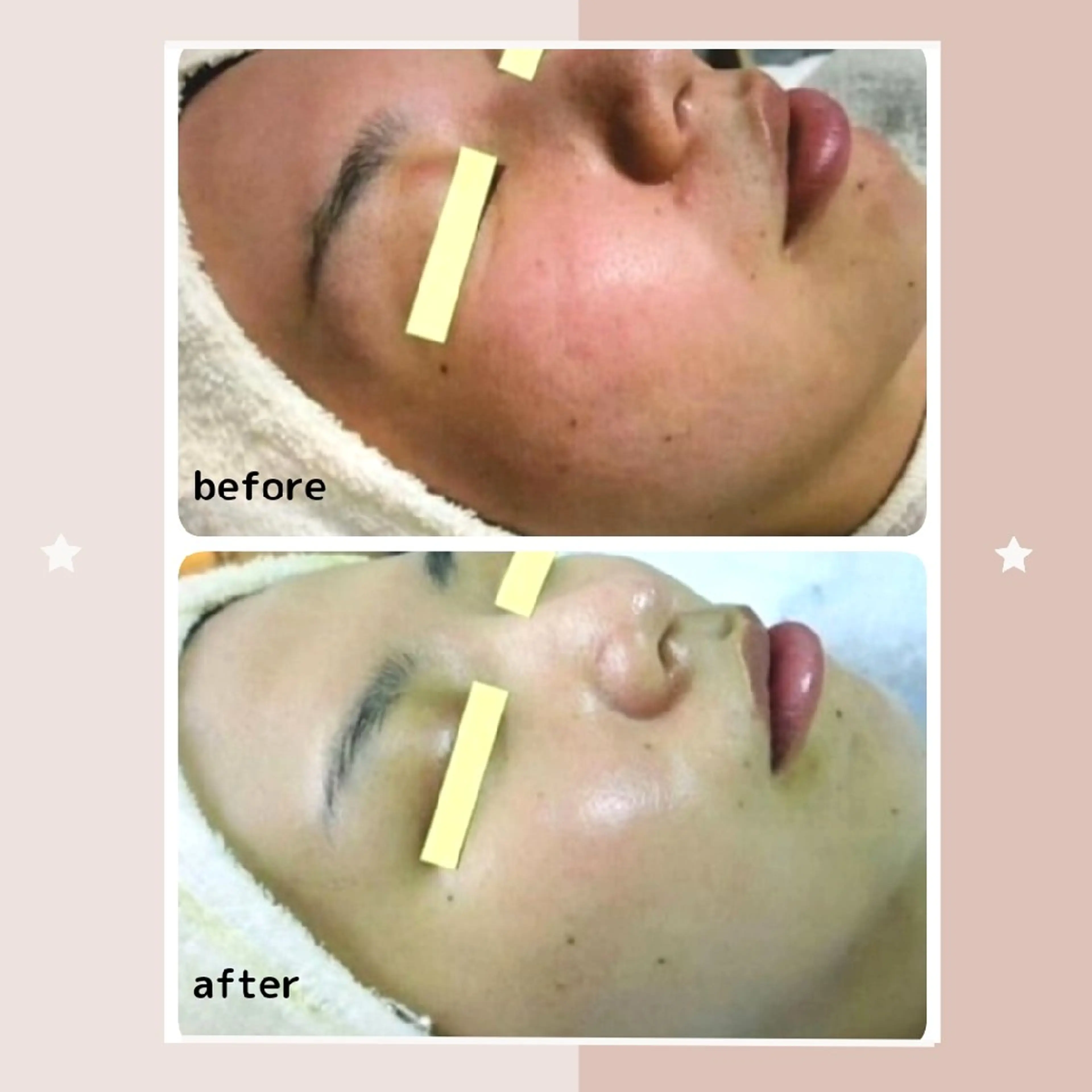 ニキビケア＆ニキビ跡 レゾン京橋店　のエステ・リラクイメージ