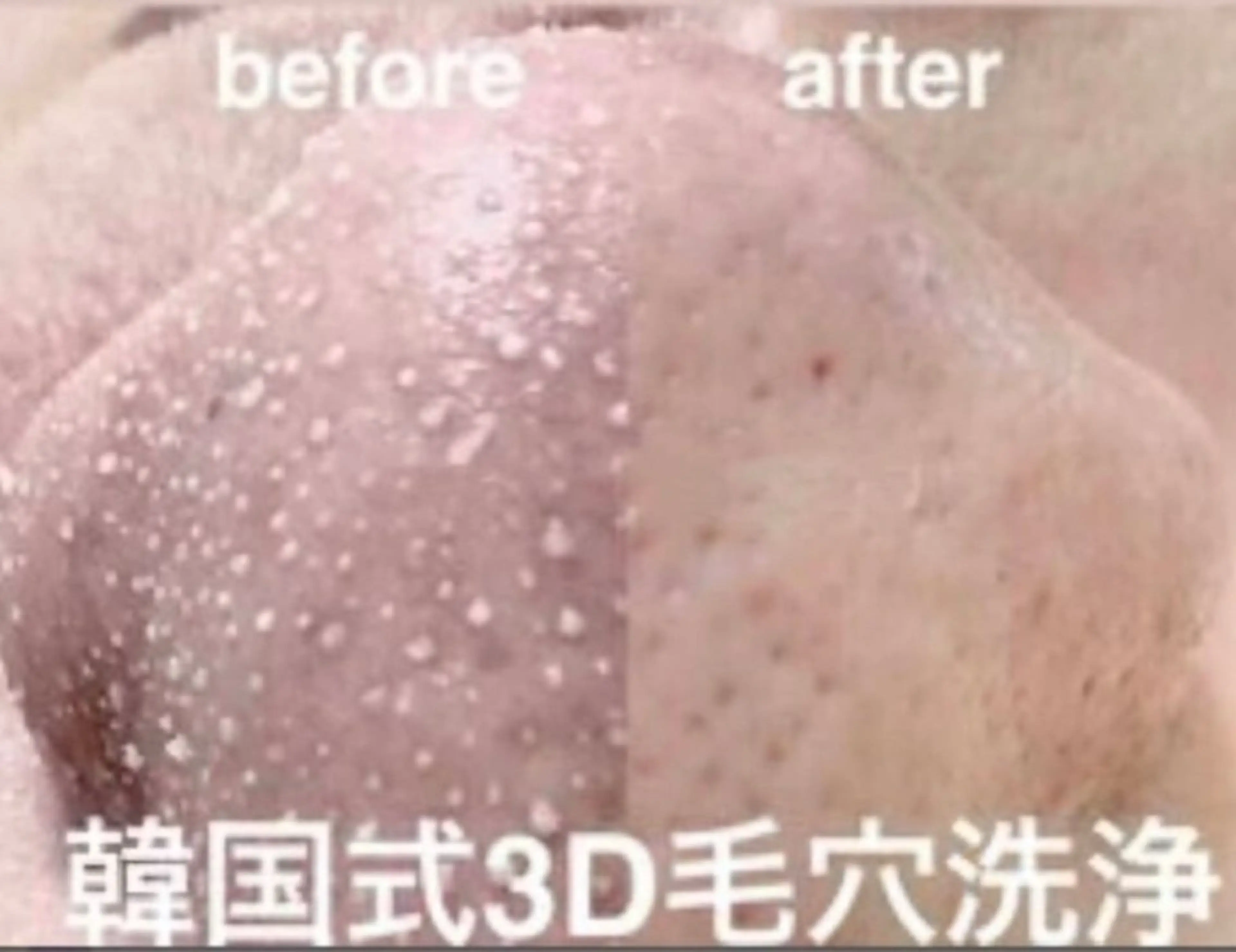 韓国式3D毛穴洗浄の写真