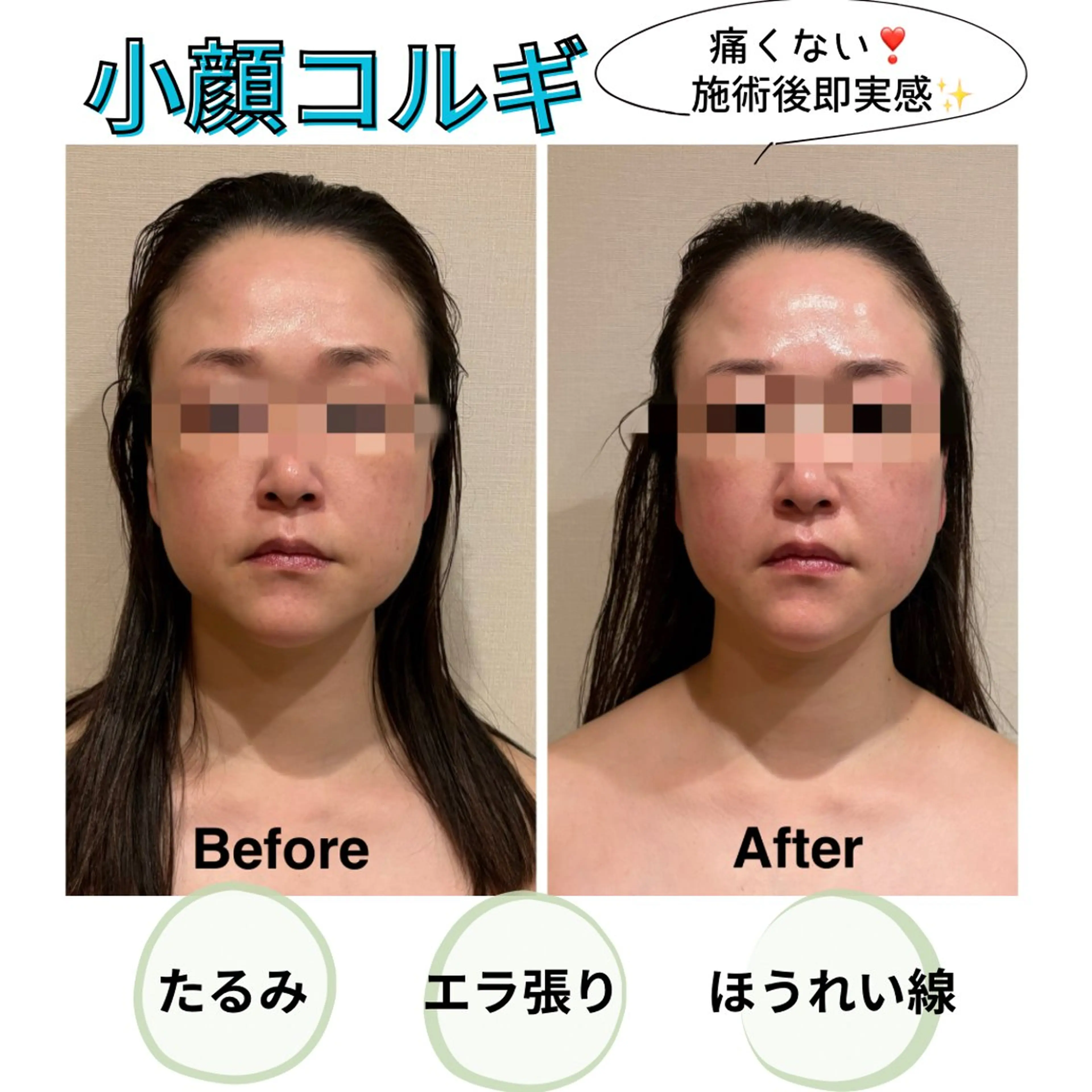 【効果即実感✨小顔コルギ❣️】歪み・たるみに❗️痛くない新感覚コルギ🙌の写真