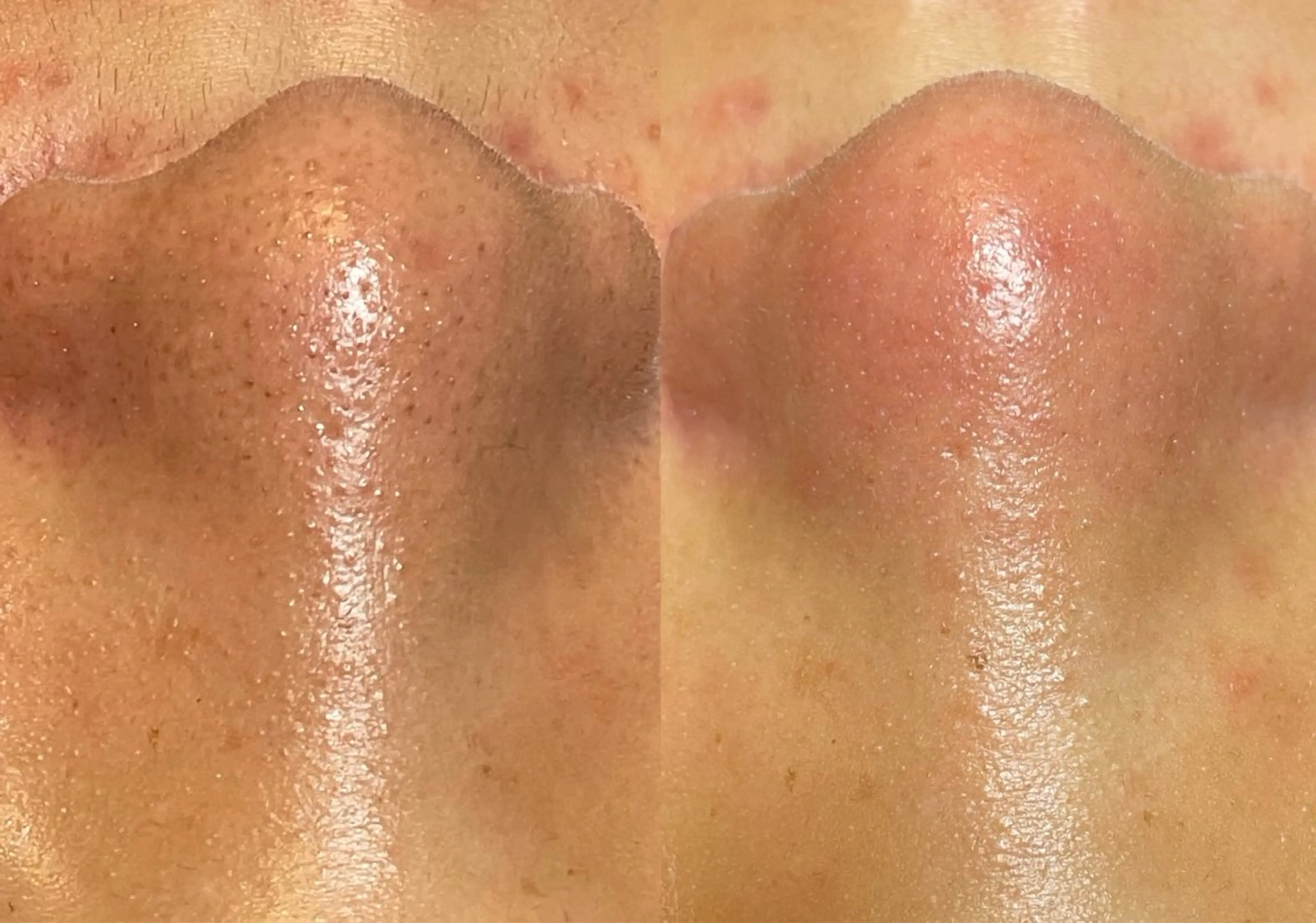 ハイドラフェイシャル(毛穴洗浄)の写真