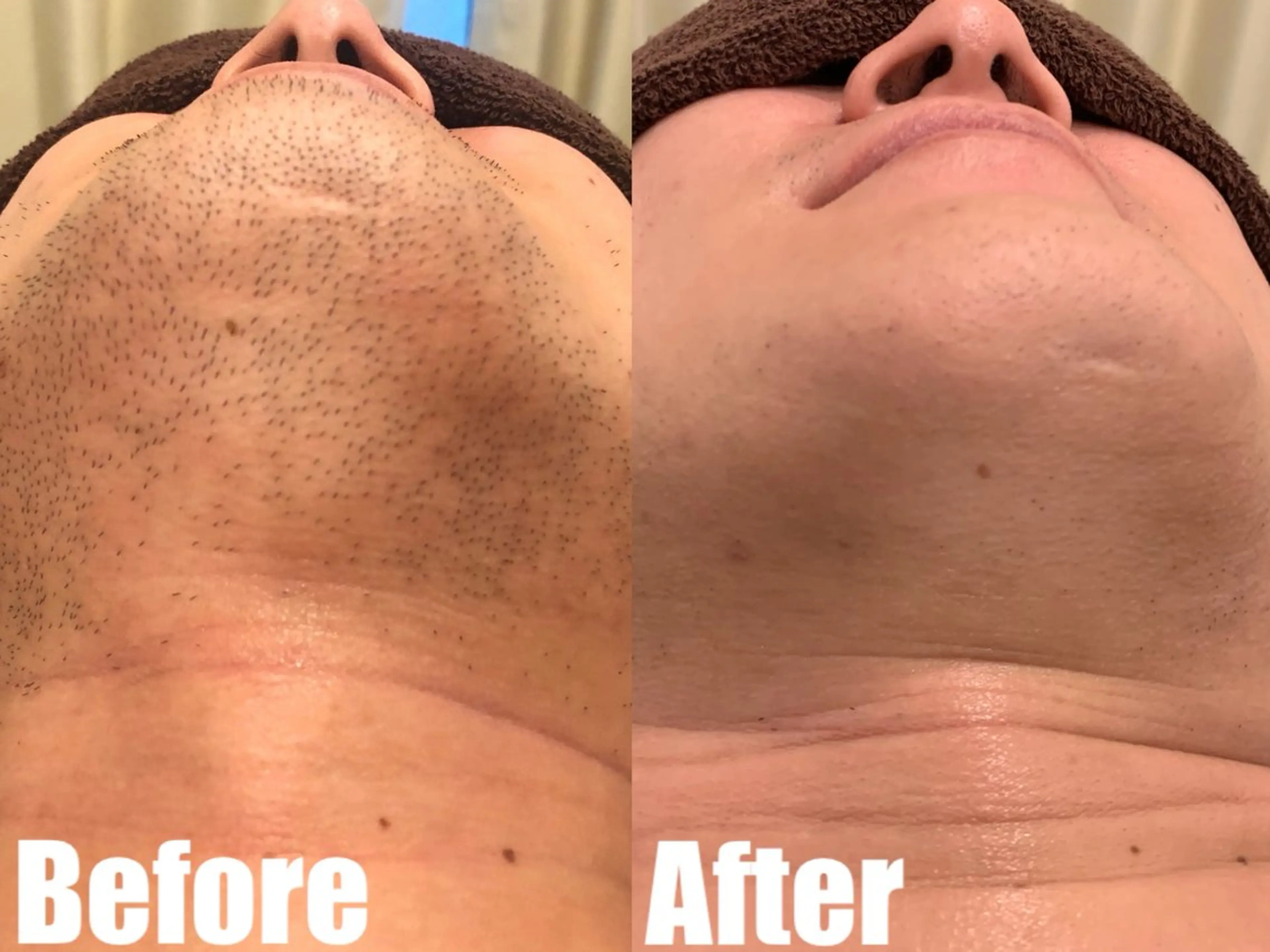 メンズ 都度払い脱毛ブレア /代々木のエステ・リラクイメージ